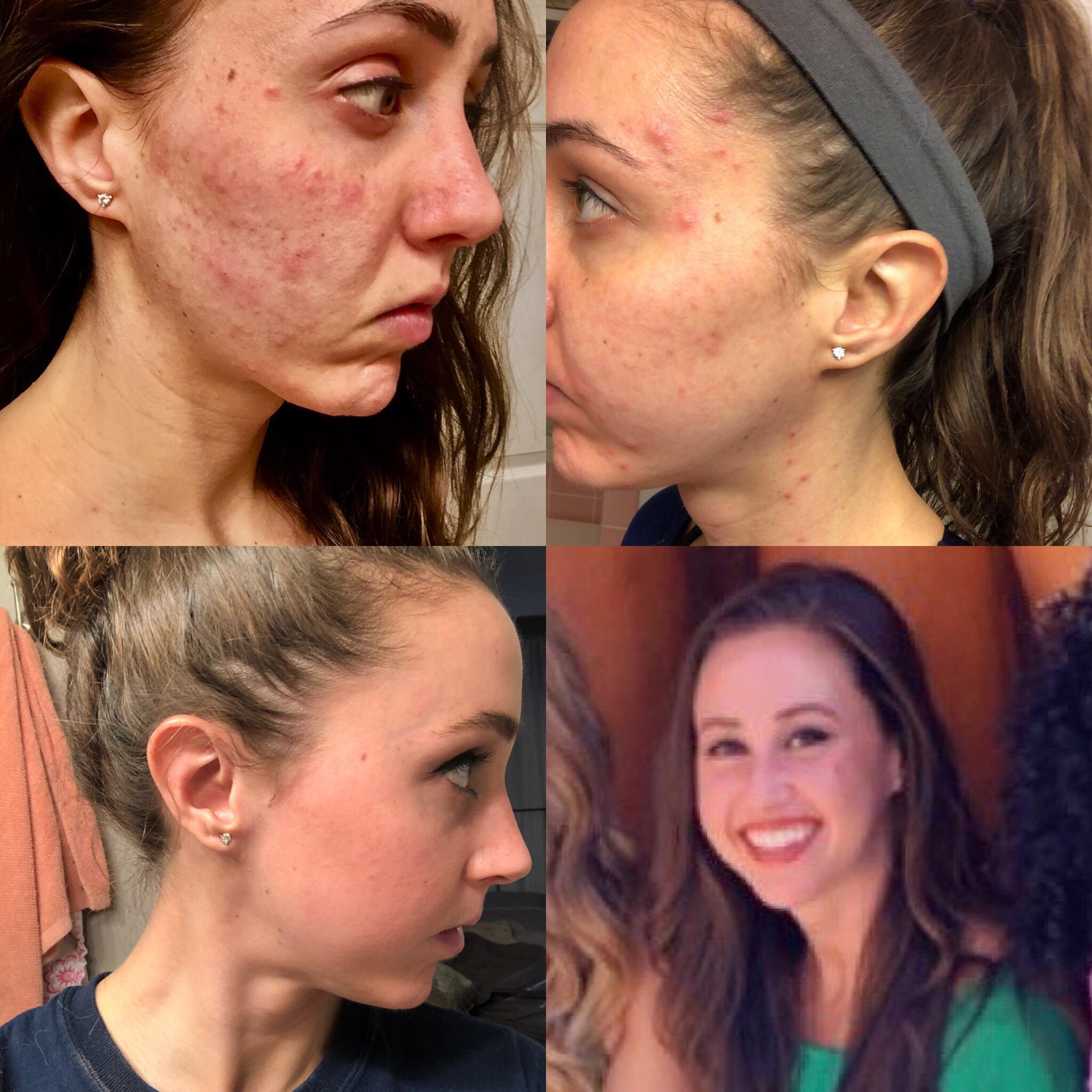 List 91+ Background Images Before And After Accutane Side Effects Updated