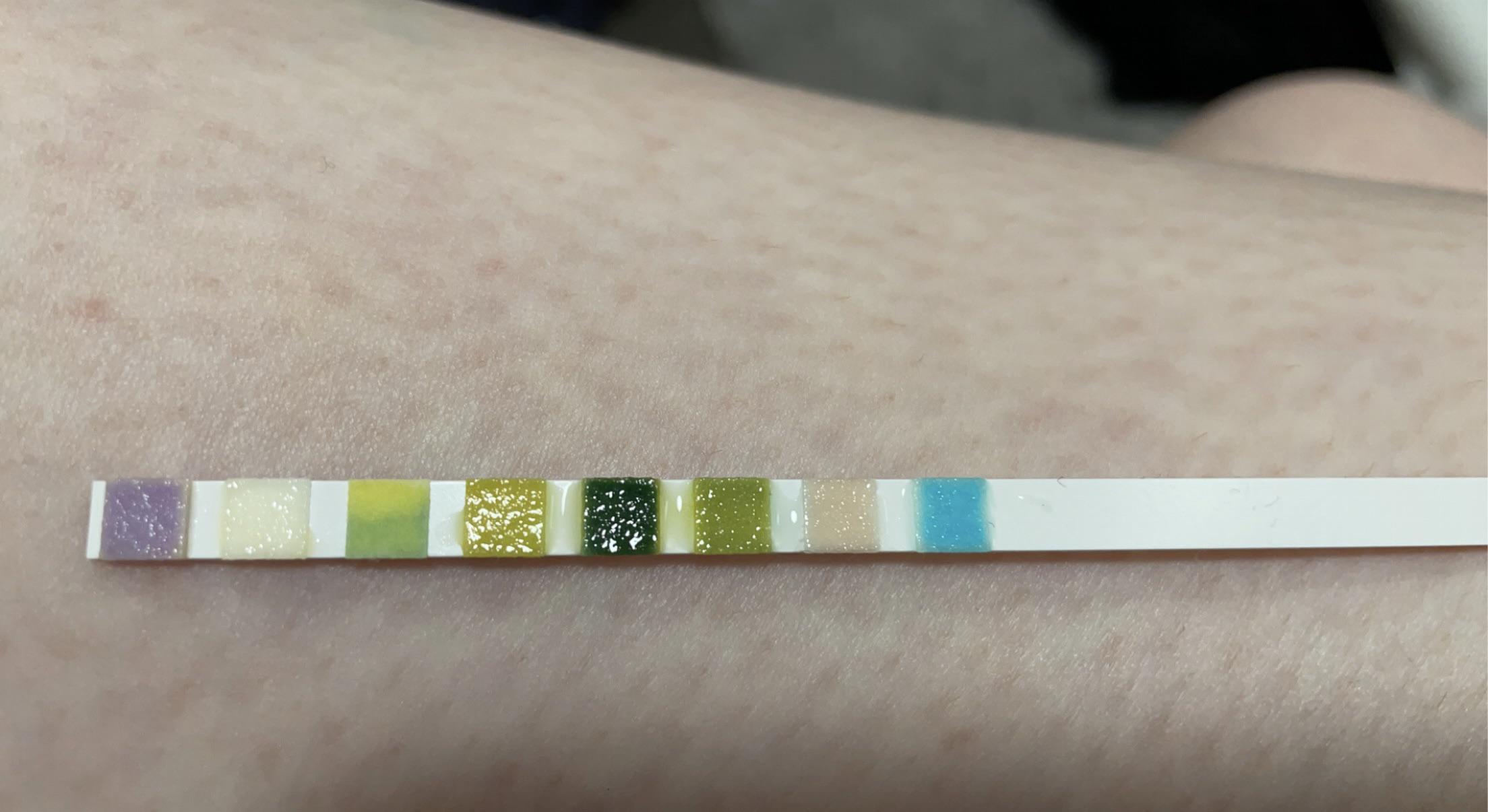 Urinalysis what does leukocytes, protein and blood in the urine mean