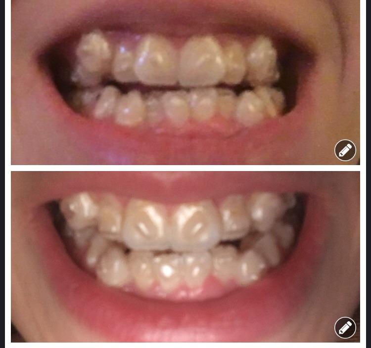 Progress Pics End of tray 10/40. I’m amazed by how fast it’s changing