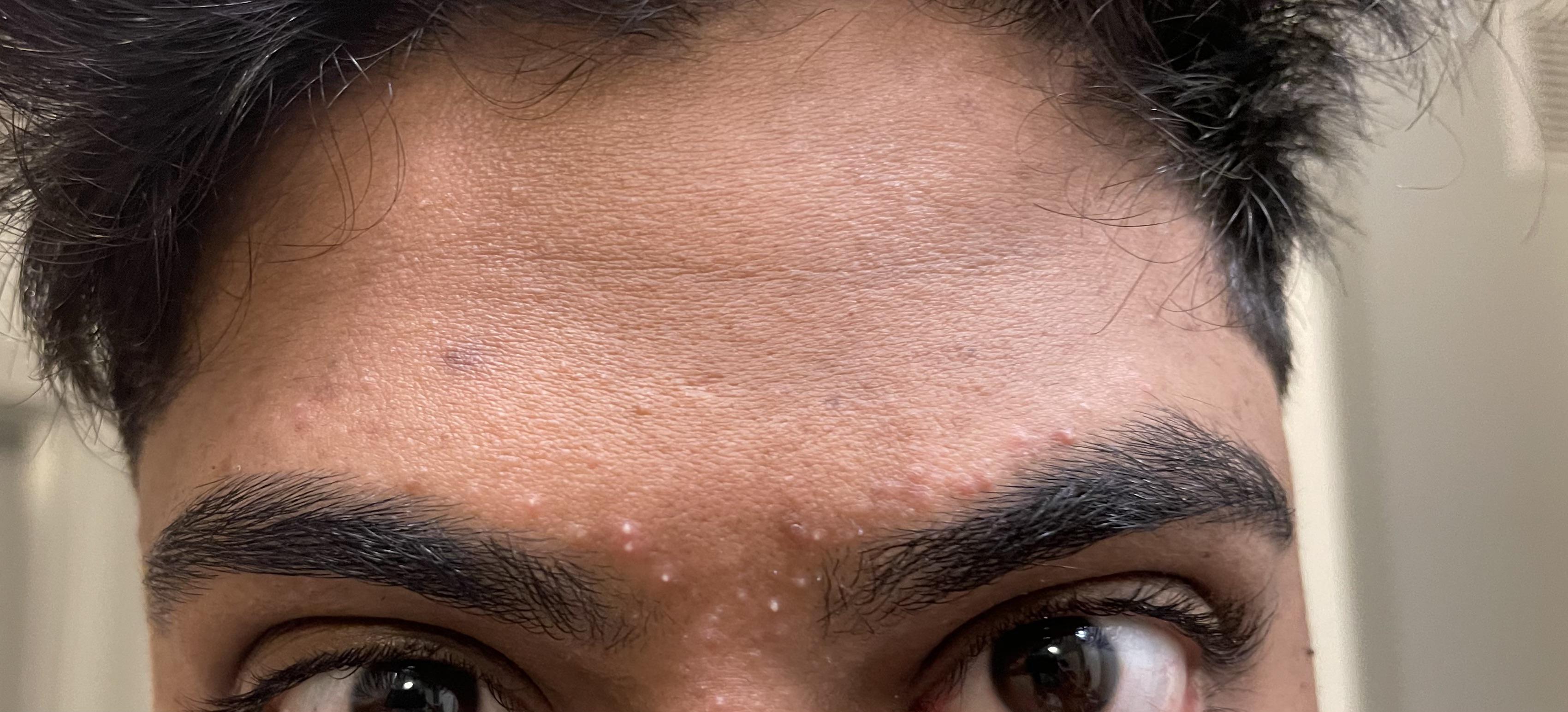 [skin concerns] Every time I get my brows waxed/threaded, these little