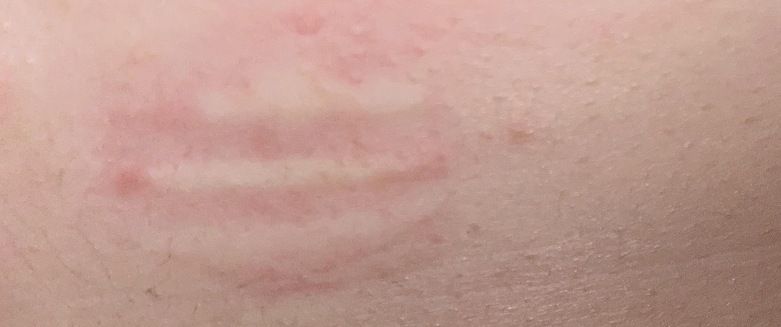 Is this a allergic reaction? I took my bandage off and boom.. r/Allergies