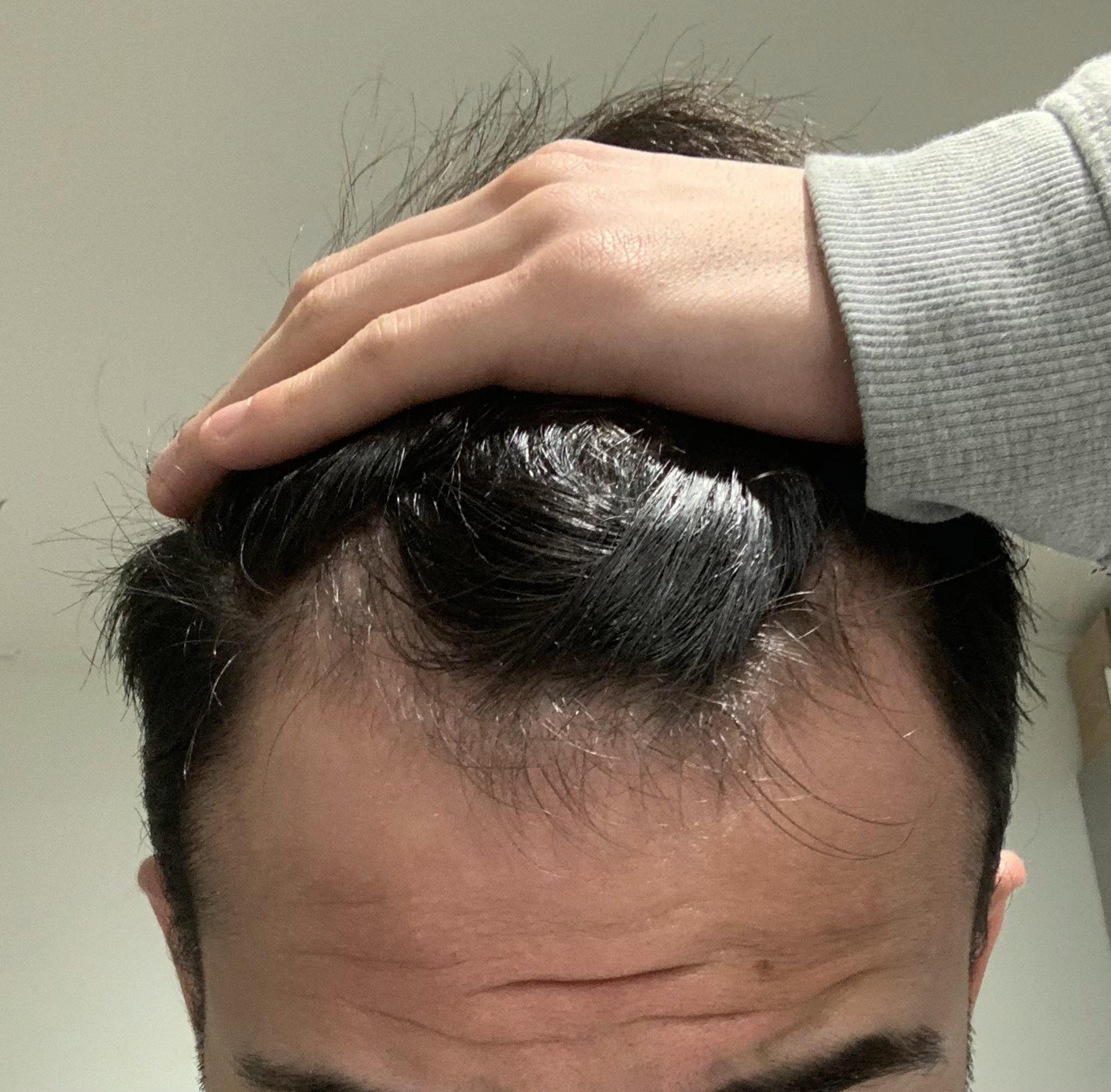 What Norwood is this r/bald