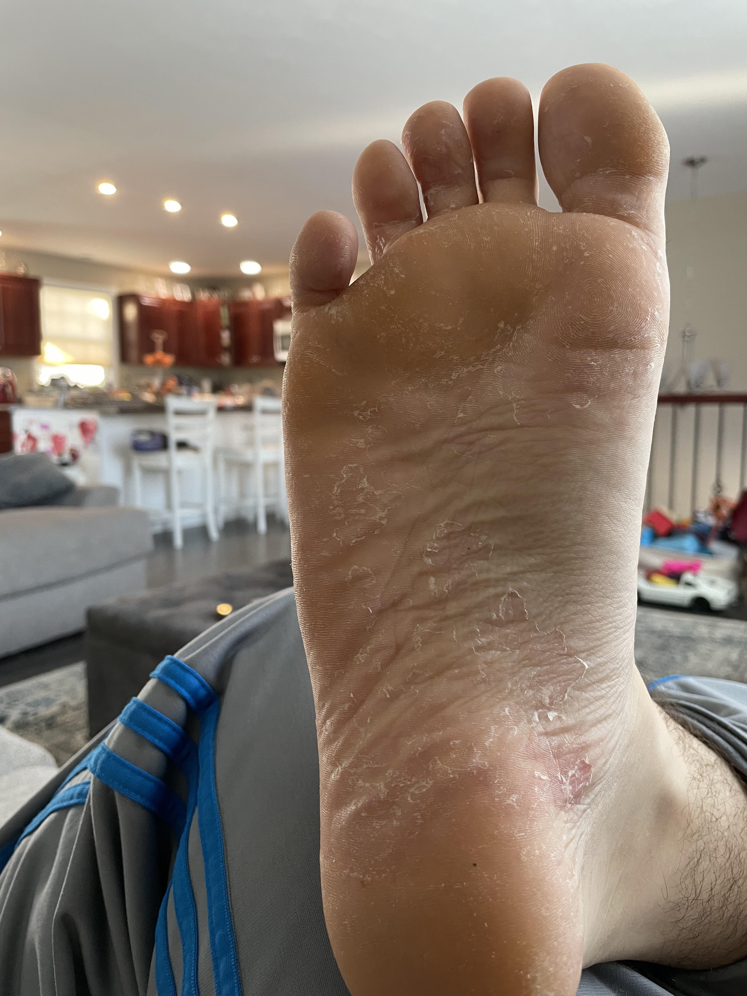Hey everyone, why does my foot look like this? It’s peeling like crazy