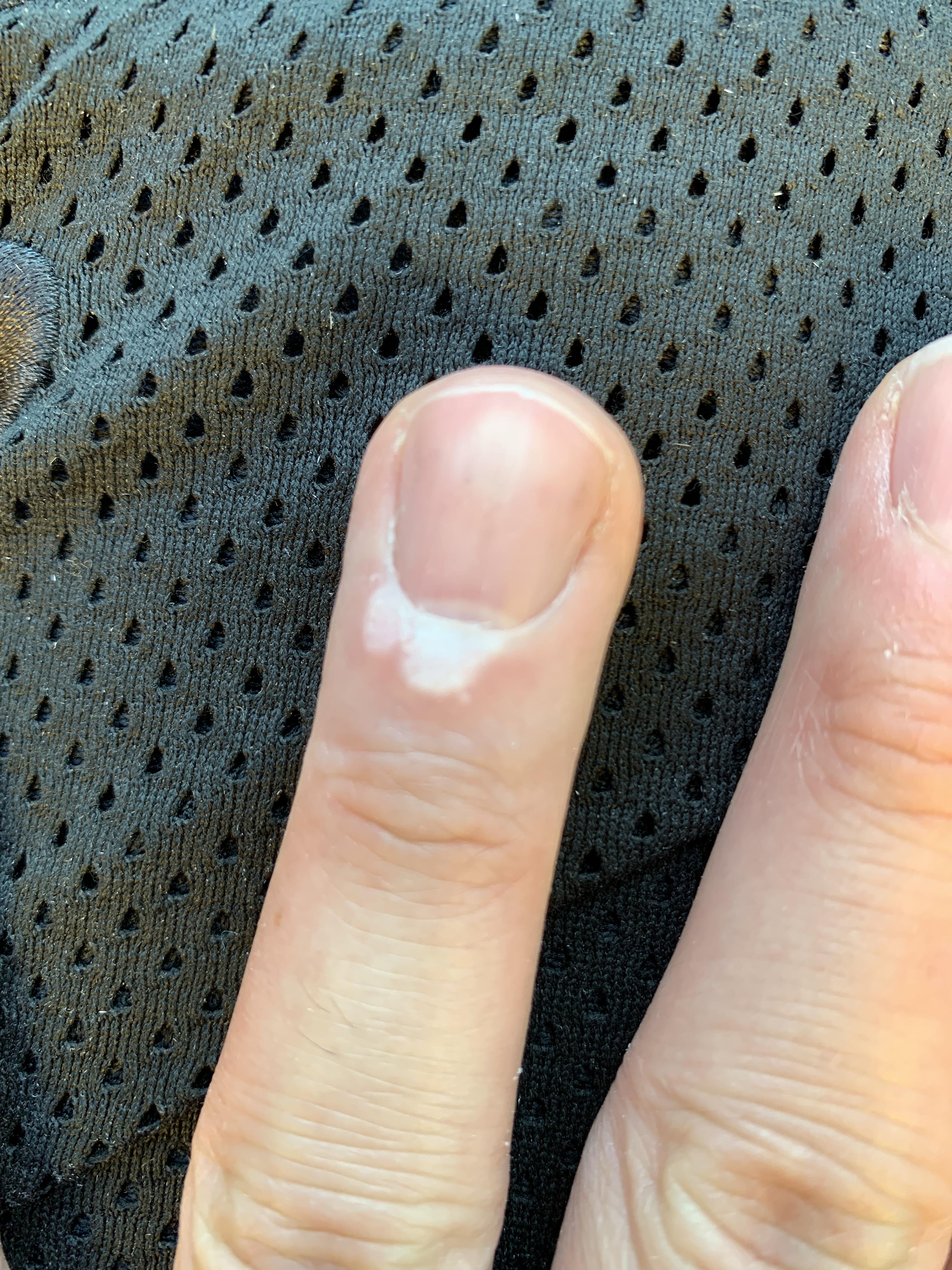 Hey all, is this a wart? If so, any tips for it? I kept it covered so