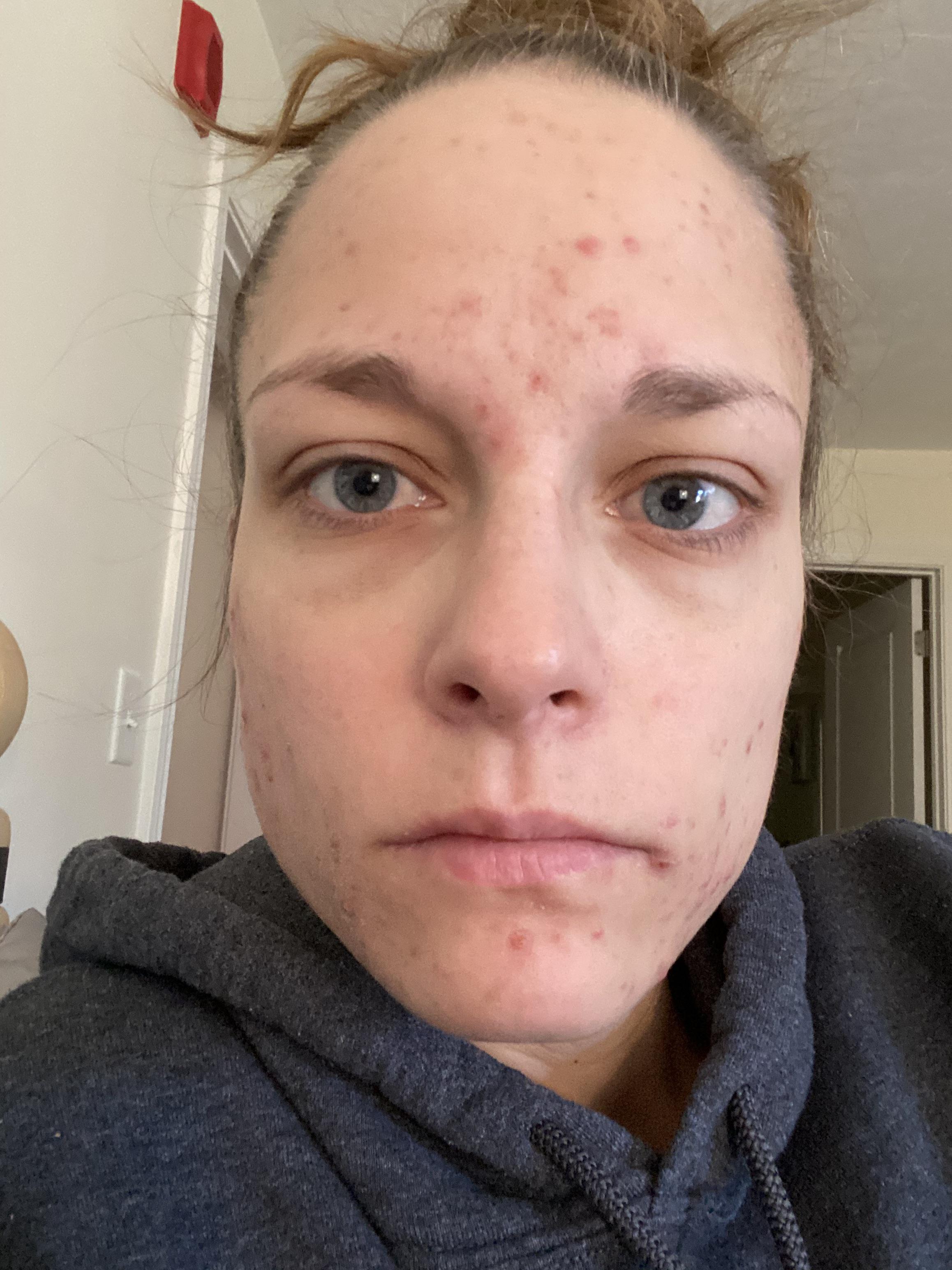 side effects Spironolactone