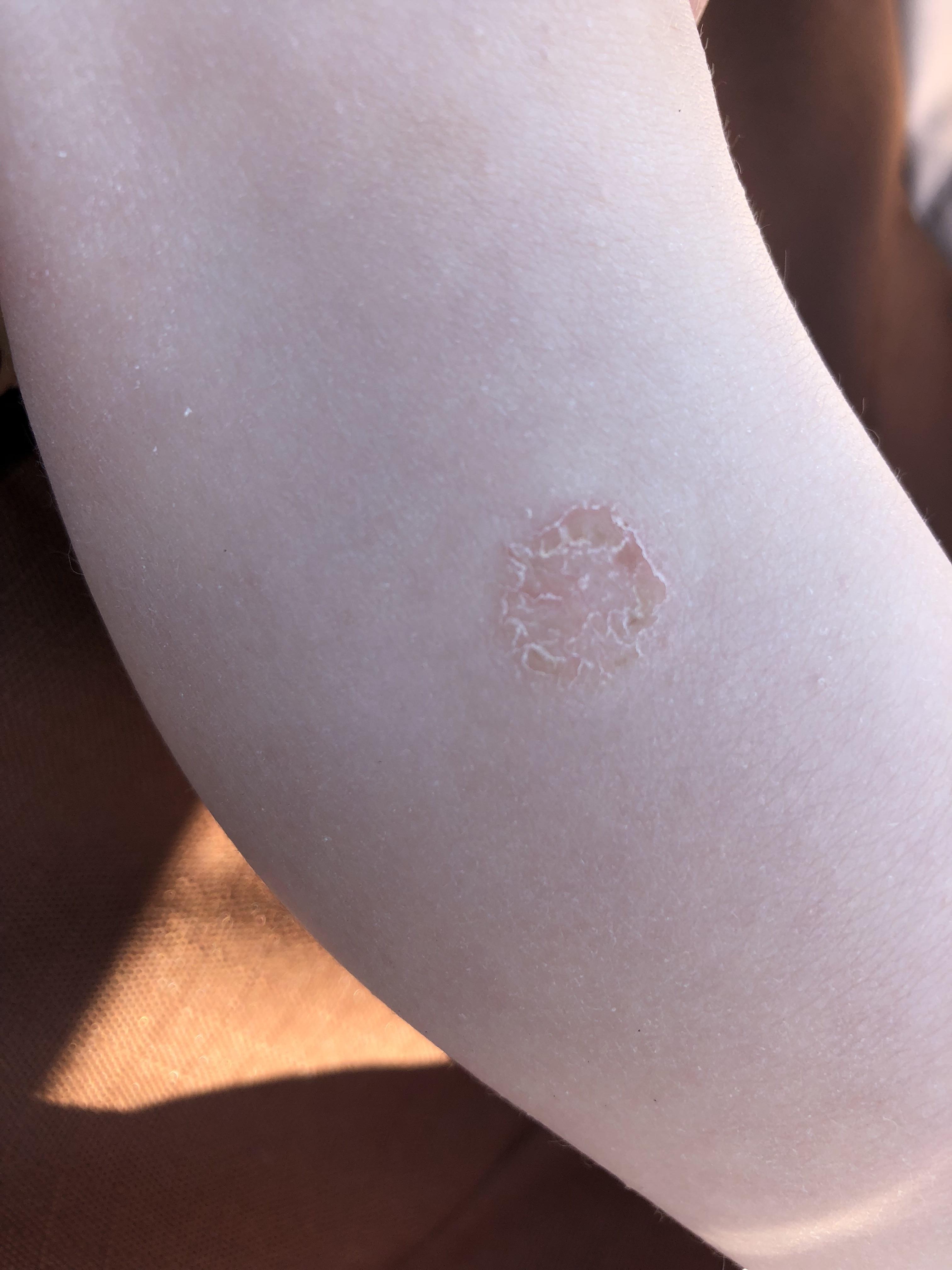 Does my child have ringworm?? r/medical