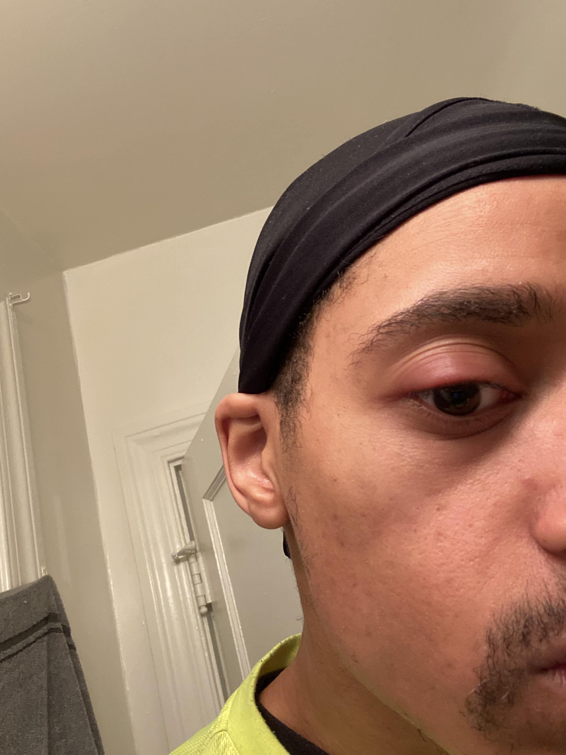 Eye swollen have tried hot compress and cold compress for a day. Good