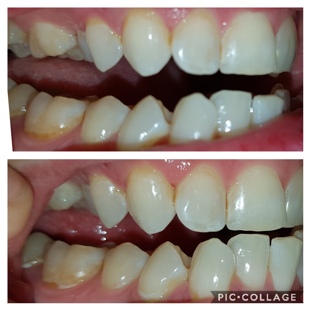 Dental Scaling did nothing? My dentist said my stains would come off