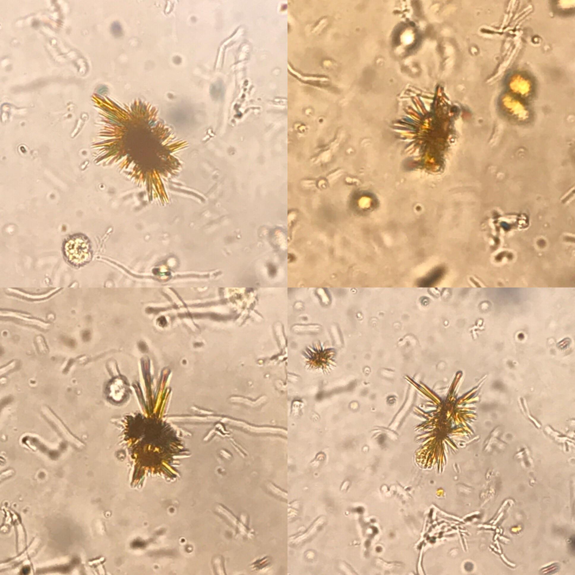 Bilirubin crystals in urine from a patient with alcoholic