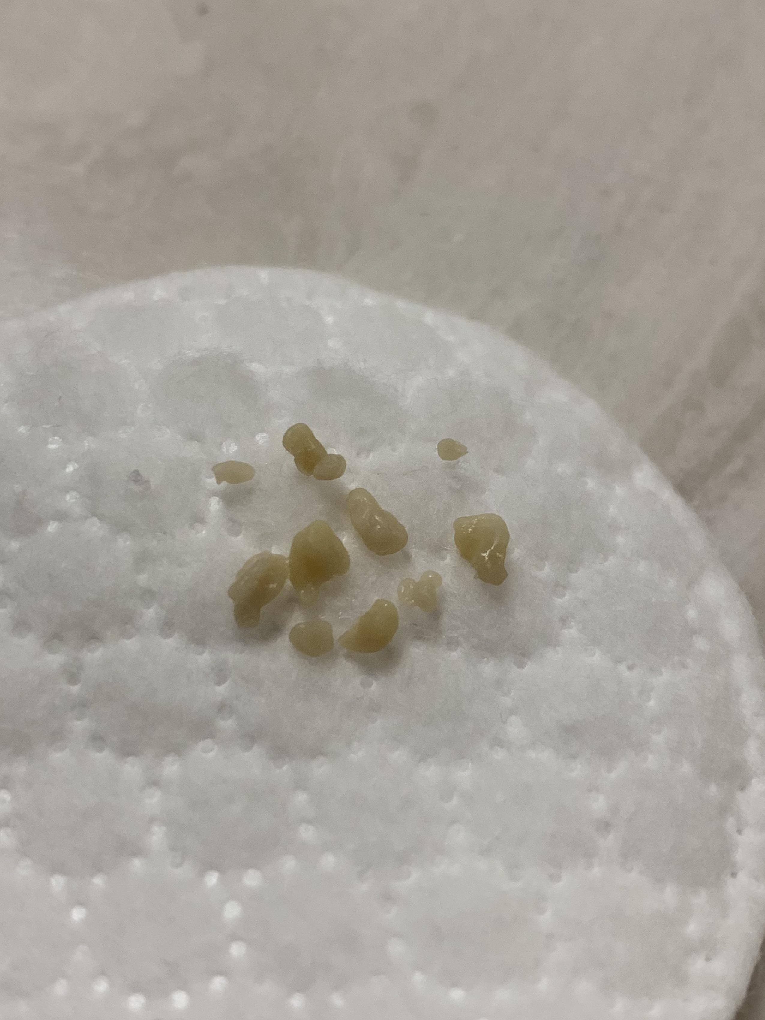 This horrifying mess of tonsil stones popped out of a crypt I didn’t