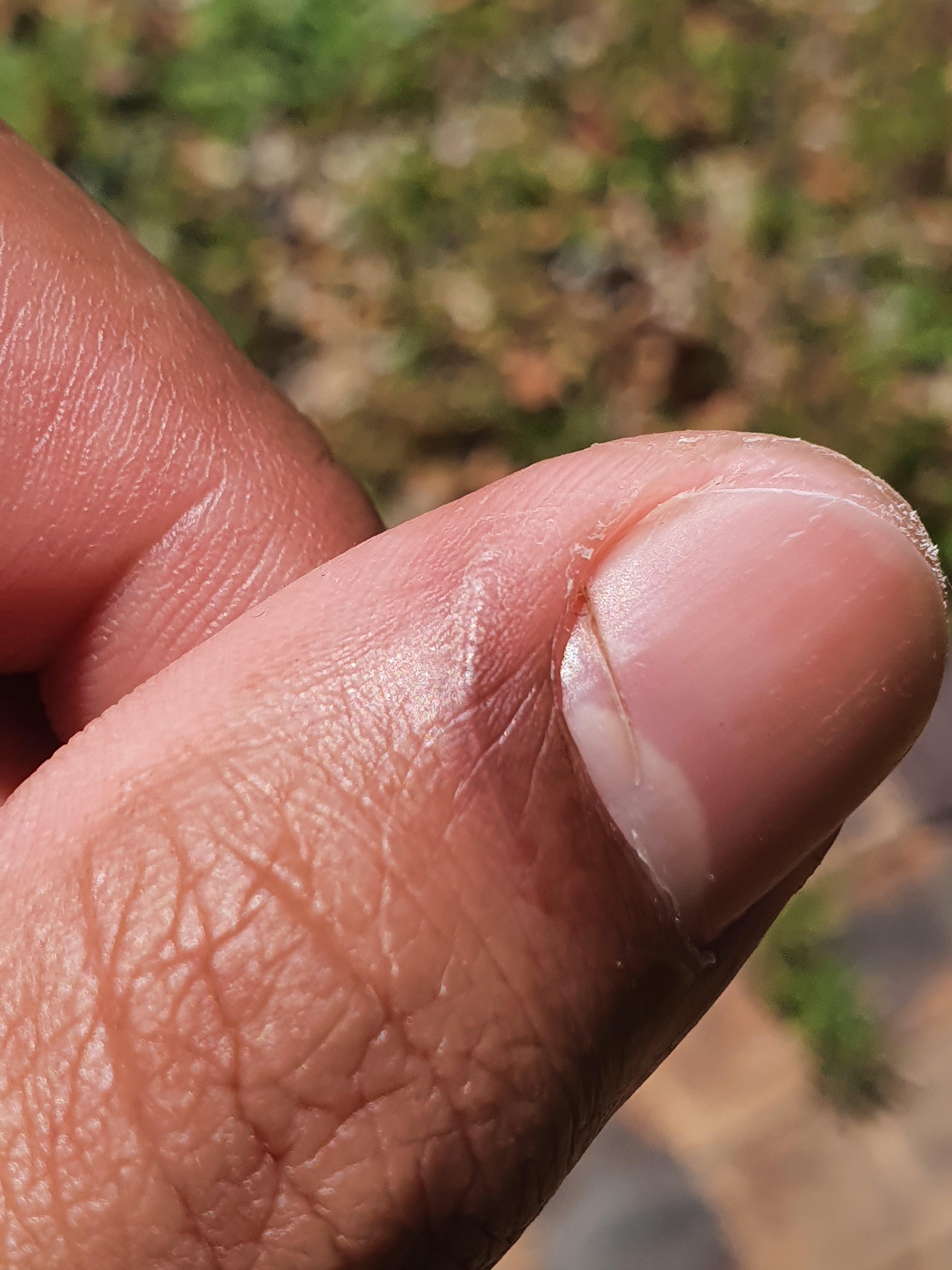 A knife cut through my nail while it was still under the skin r