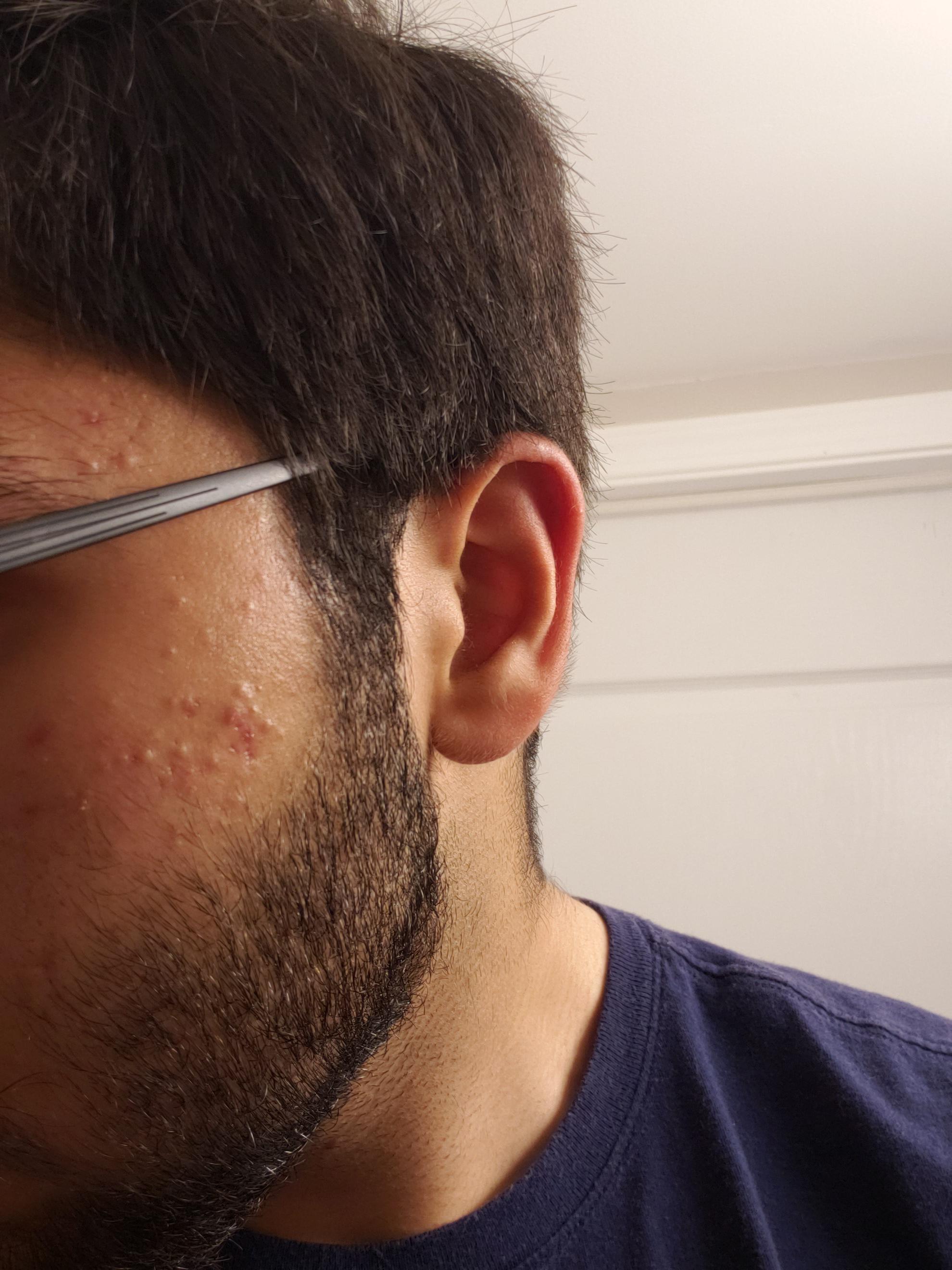 [acne] help please! How do I get rid of these bumps/red spots on my