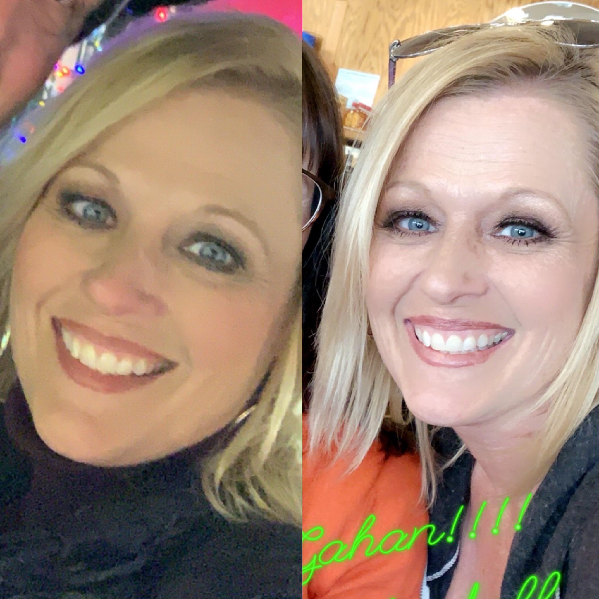 Face to Face ADF. 1 month alternate day + keto. 11 lbs down! r/AlternateDayFasting