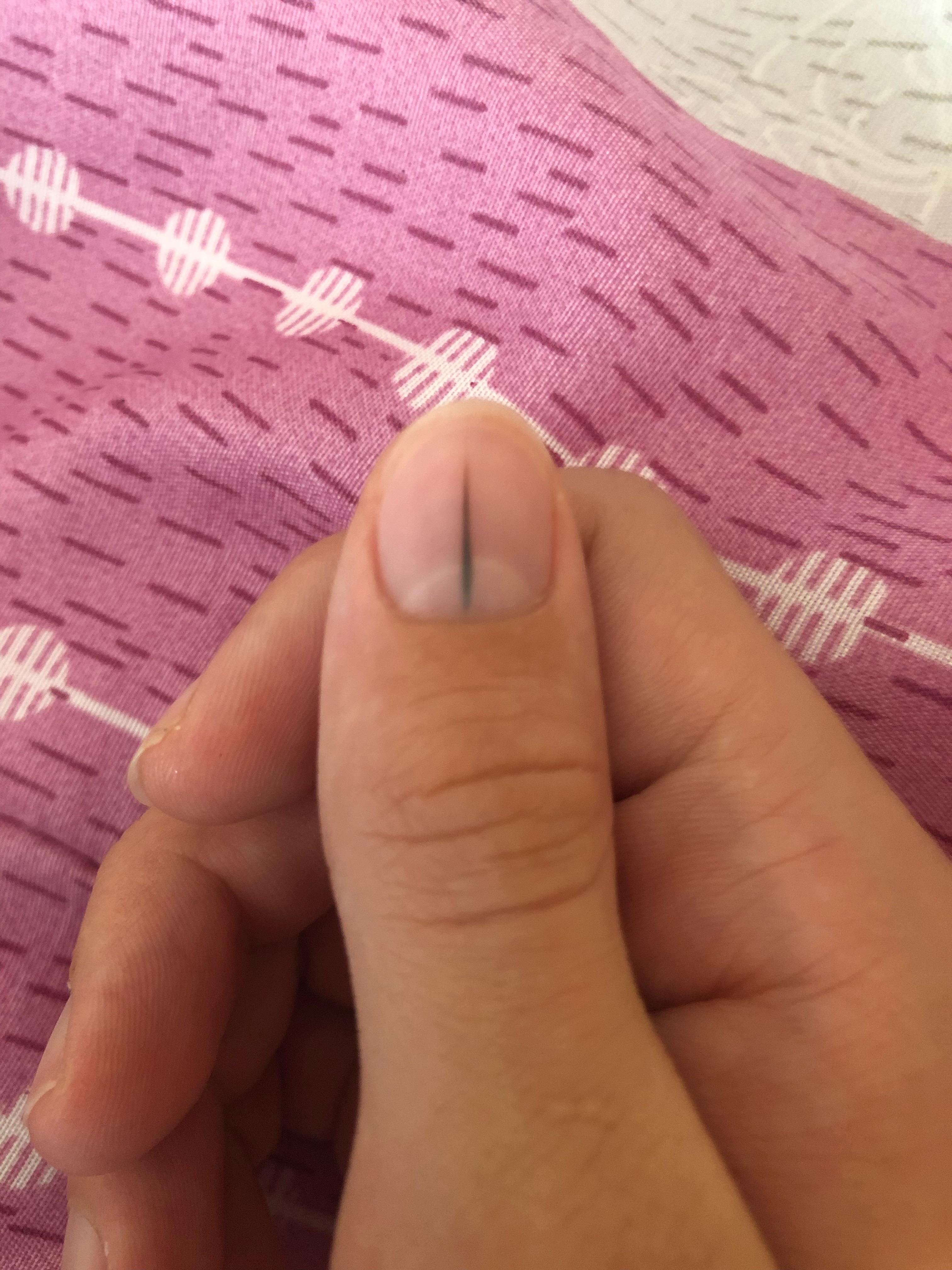 Whats this line on my thumb nail? r/medical