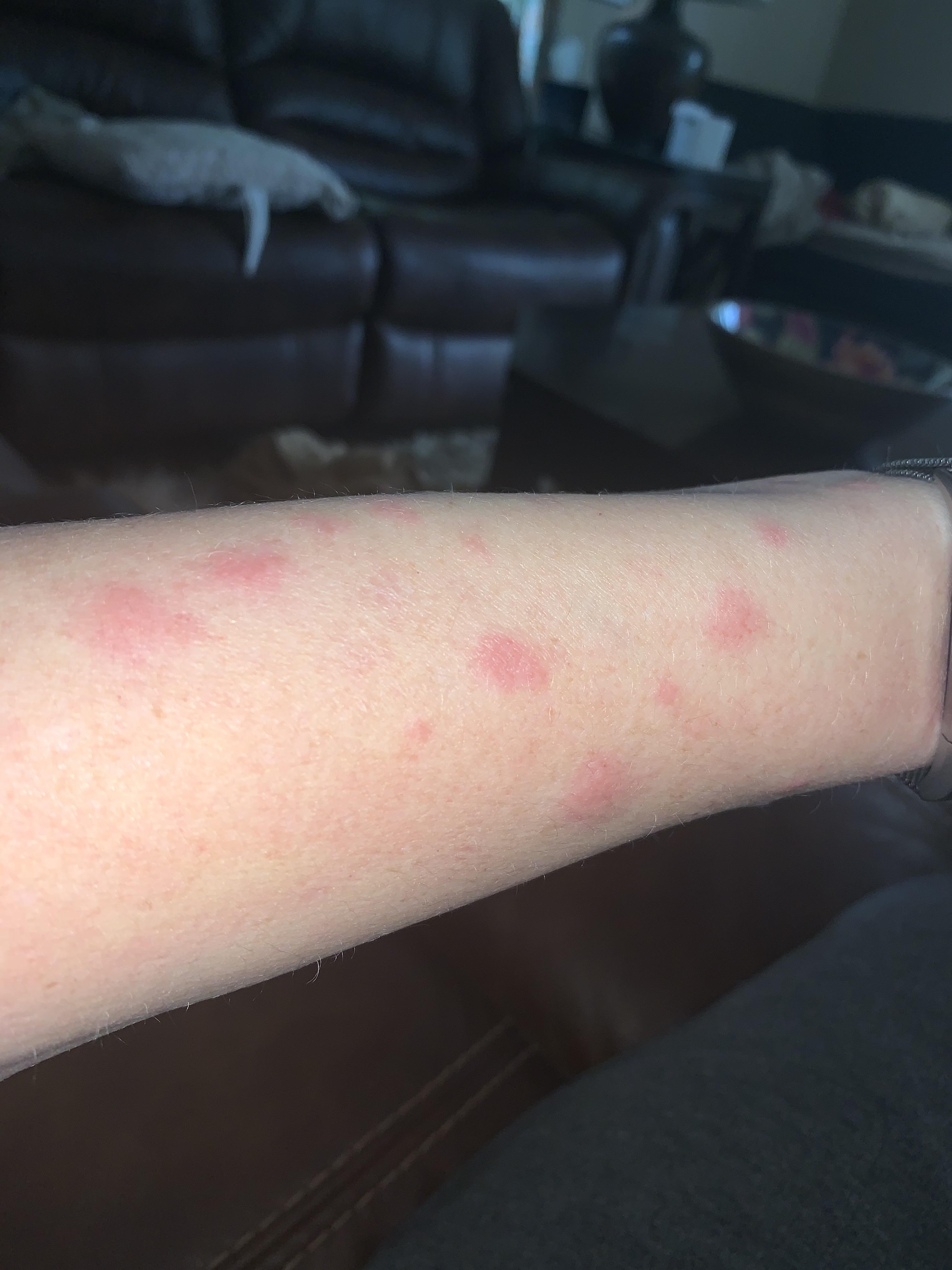 Red marks increased over last couple weeks. Very itchy and irritating, hands and arms only