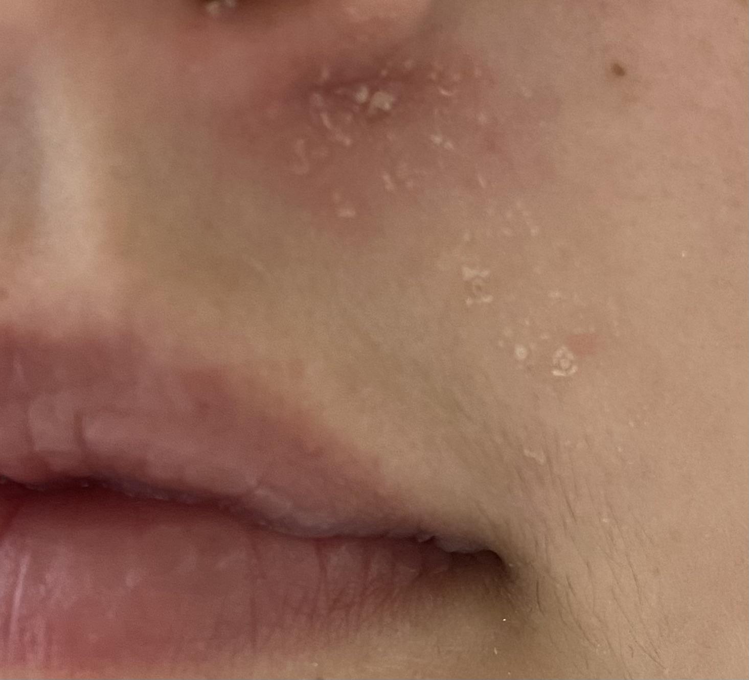 For years I’ve had a patch of red, dry and flaky skin under my nose. I