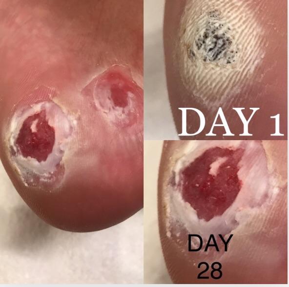 Update on the plantar warts. Still wart sticking with duct tape
