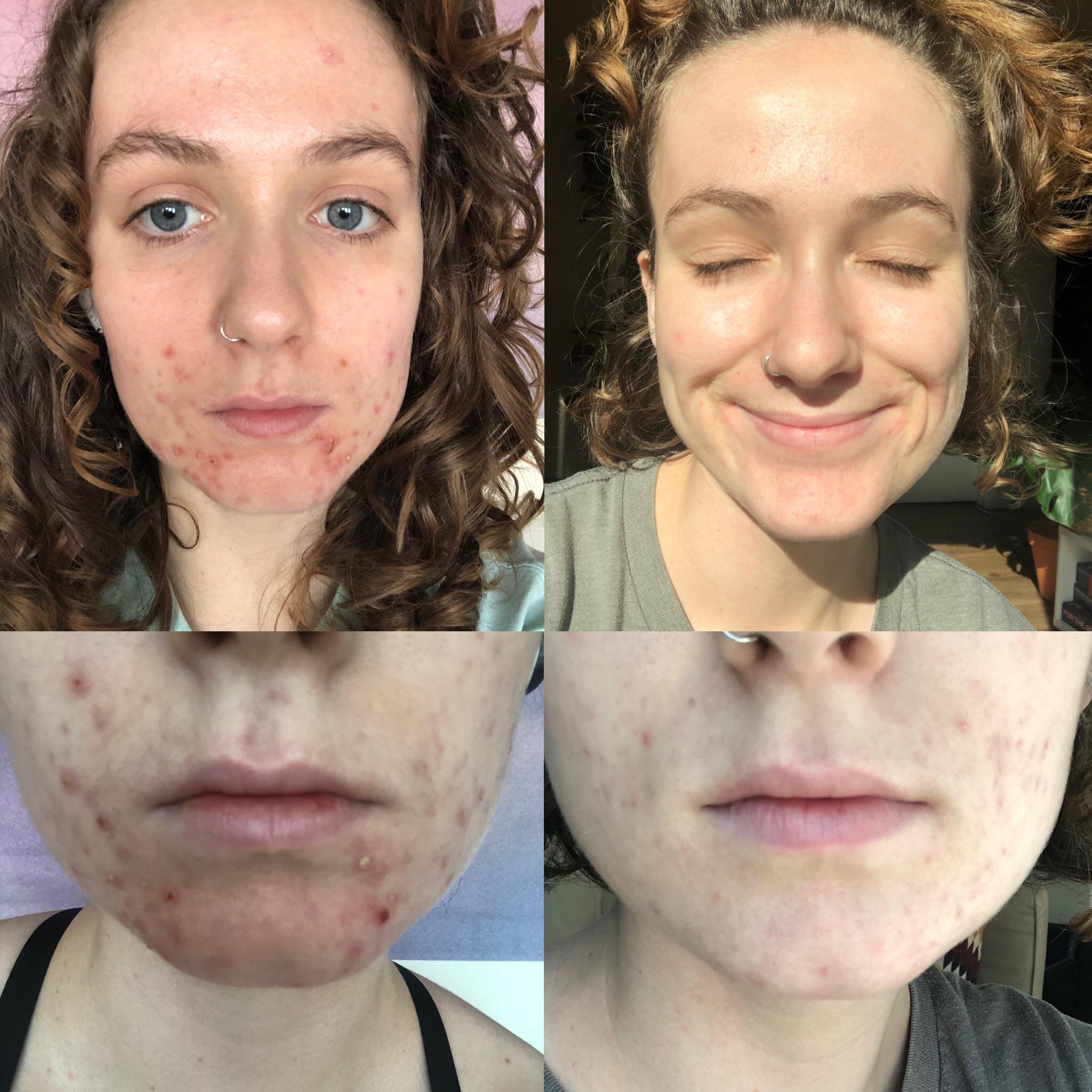 slow and steady wins the race ) 6 months on spiro and tret 0.1 and I