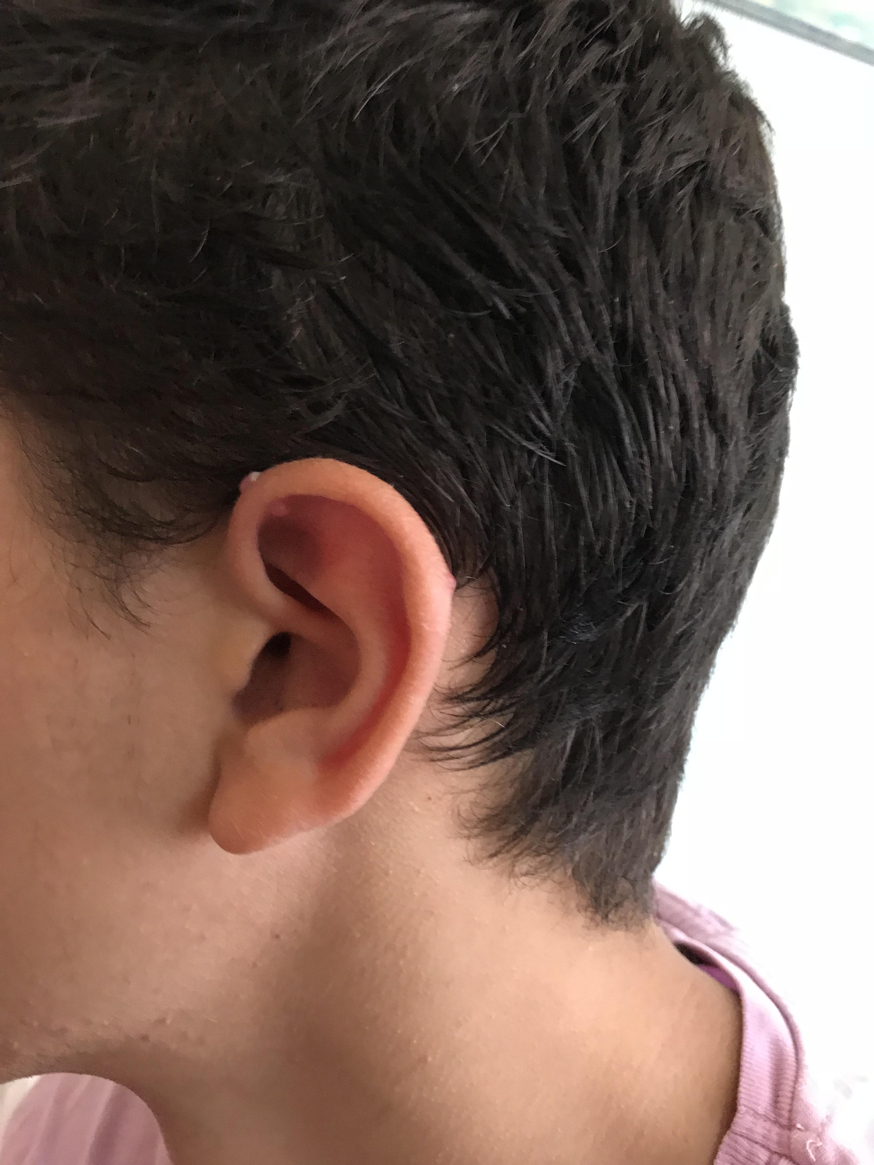 What should I do about industrial bump? ( r/piercing