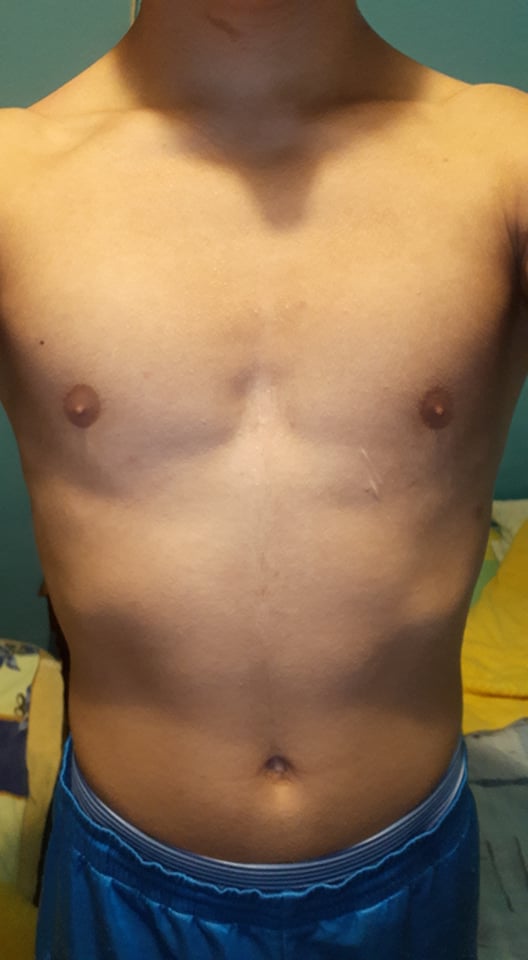 Can You Get A Big Chest With Pectus Excavatum at Araceli West blog