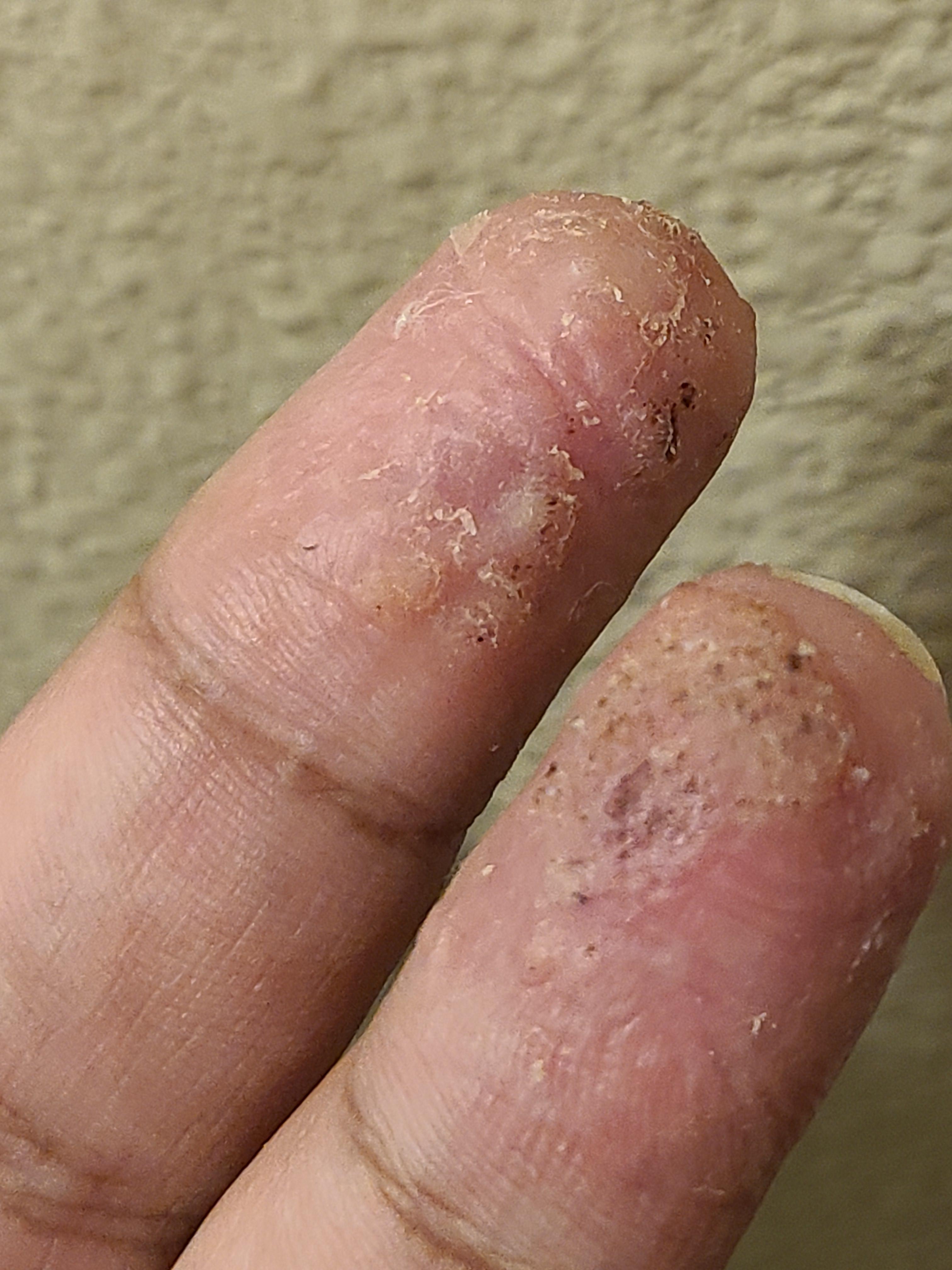 Did Apple cider vinegar for a week and half. What's next for me? r/Warts