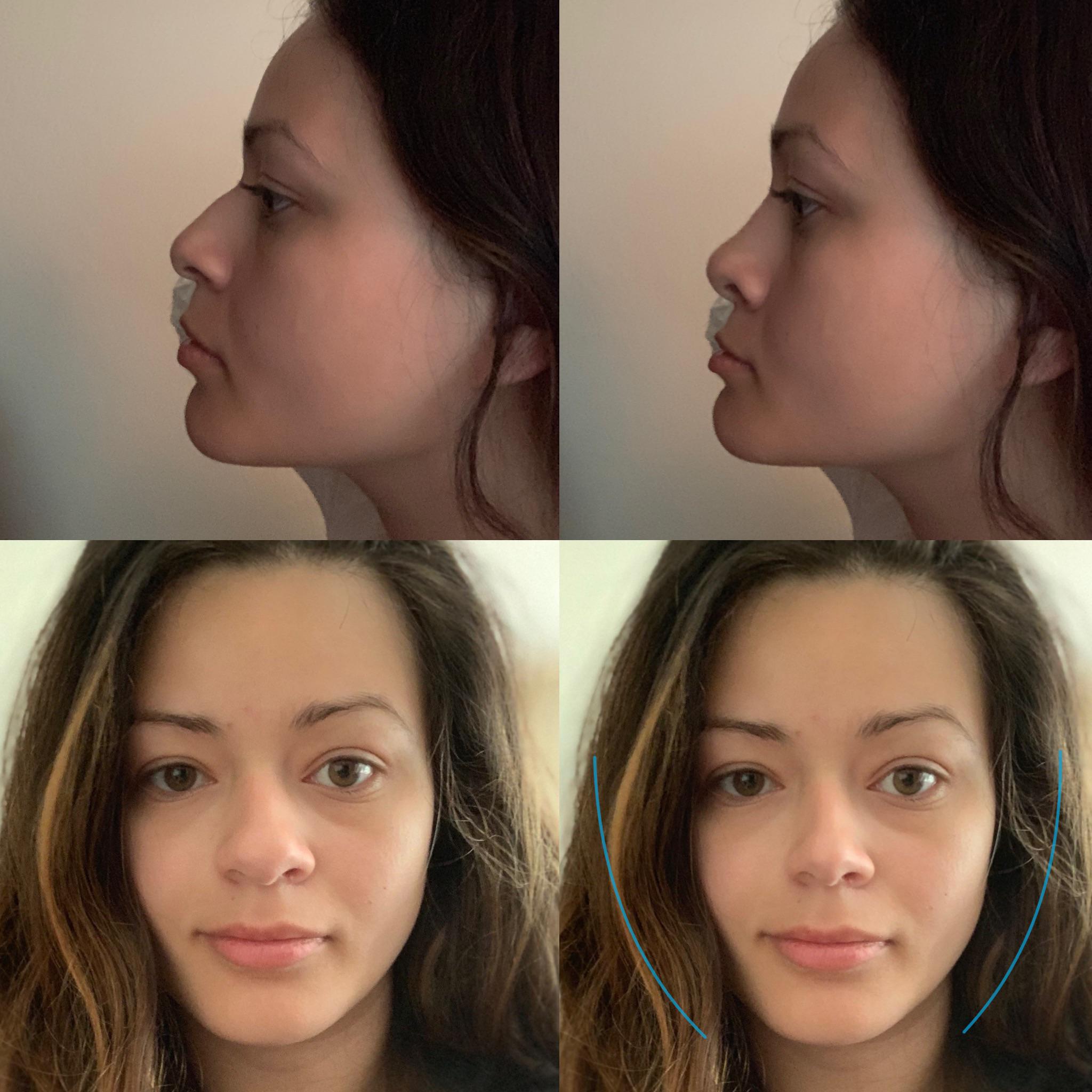 Rhinoplasty My Journey r/PlasticSurgery
