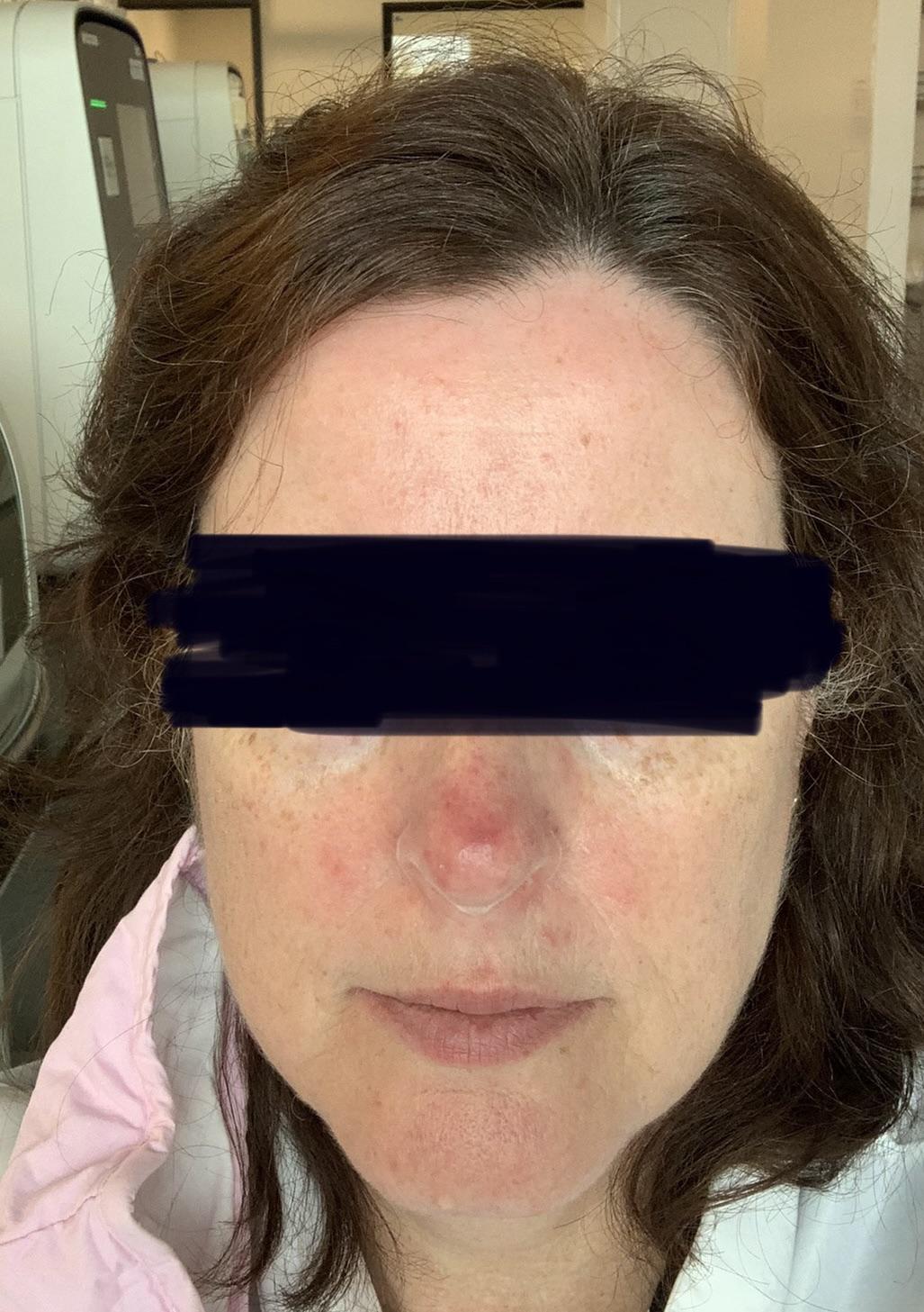 How to get rid of nose redness? I’ve tried everything. r/SkincareAddicts