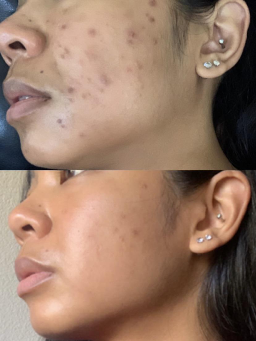 [b&a] 139 days ago and today!!!!! SkincareAddiction