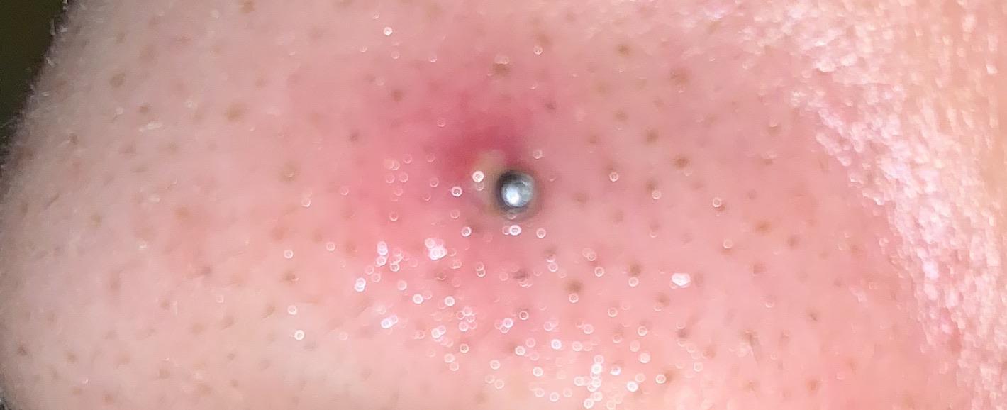 What is this bump nose piercing. Can anyone help me with this. I’m