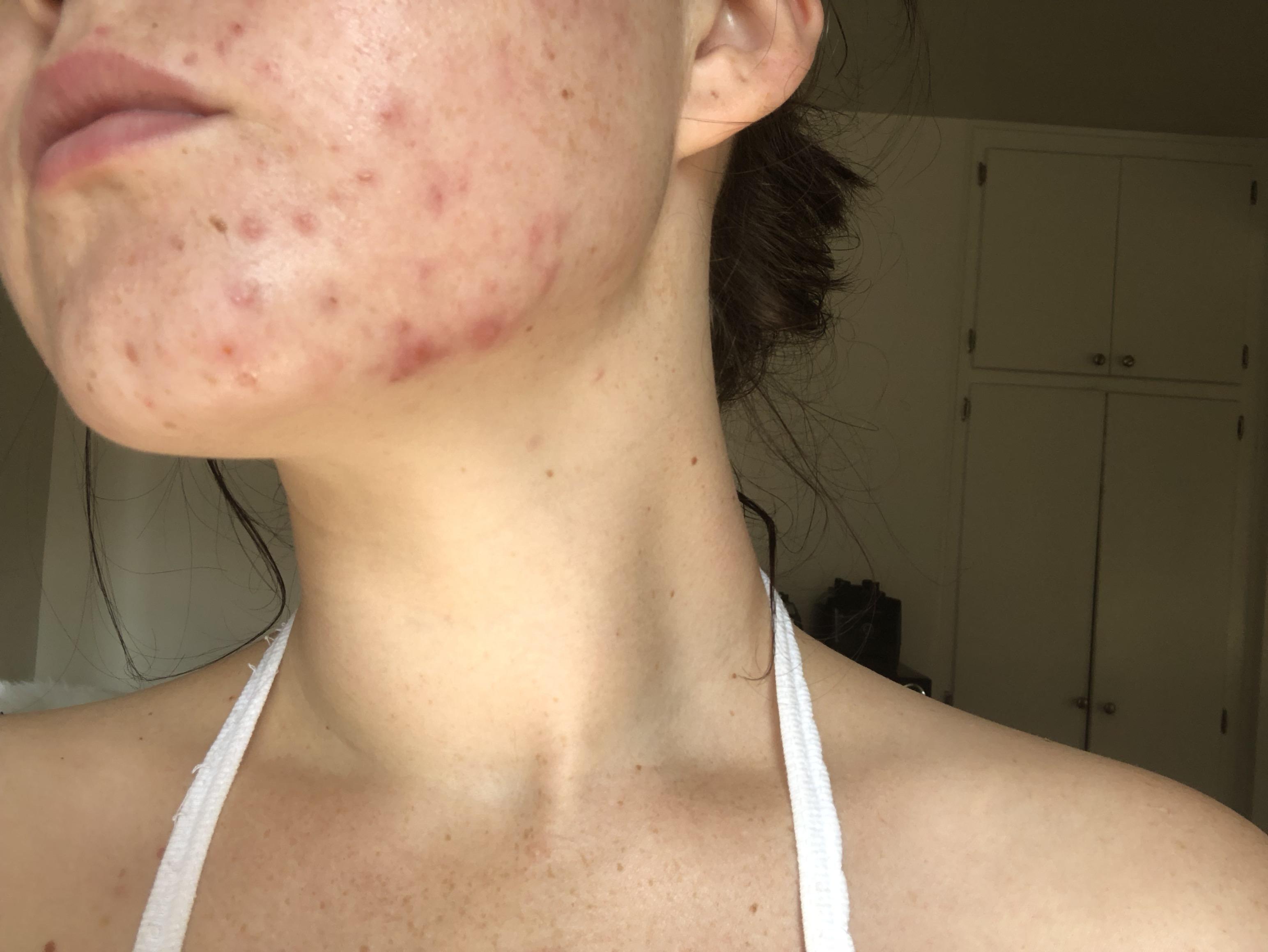 Caffeine And Acne Reddit acne symptoms