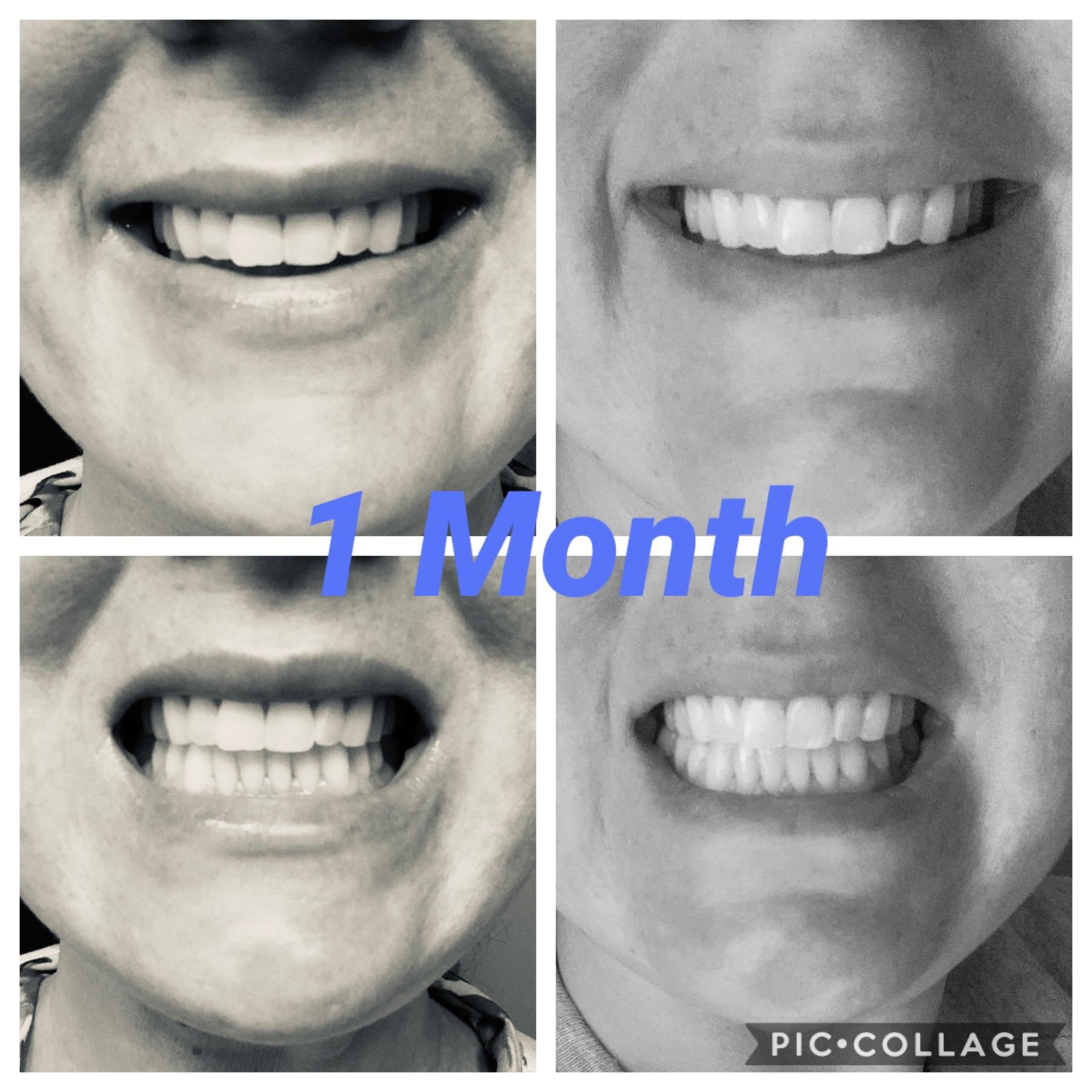 37 yo F 1 month Mewing. Narrow pallet has expanded so much I can