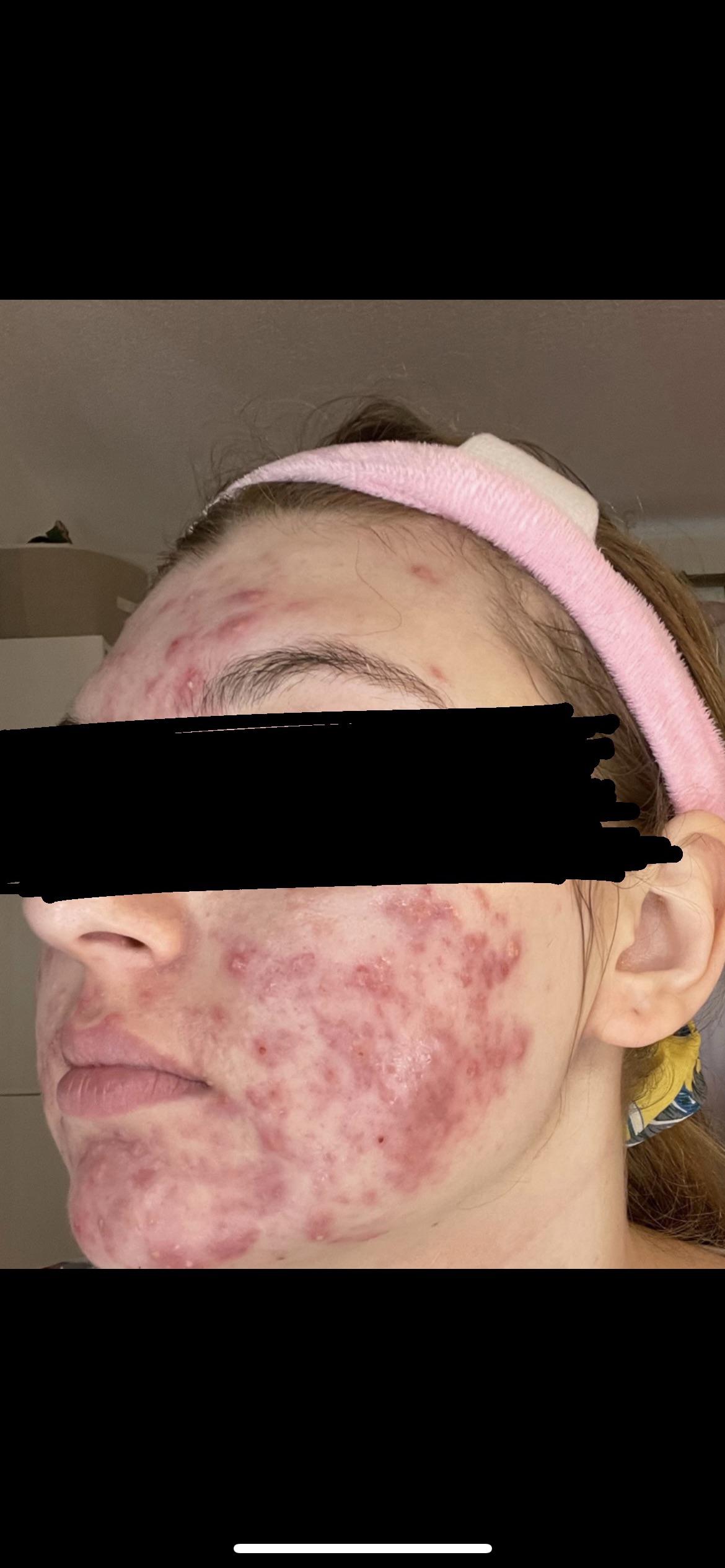 Went on birth control for a year for acne and it did wonders, came off