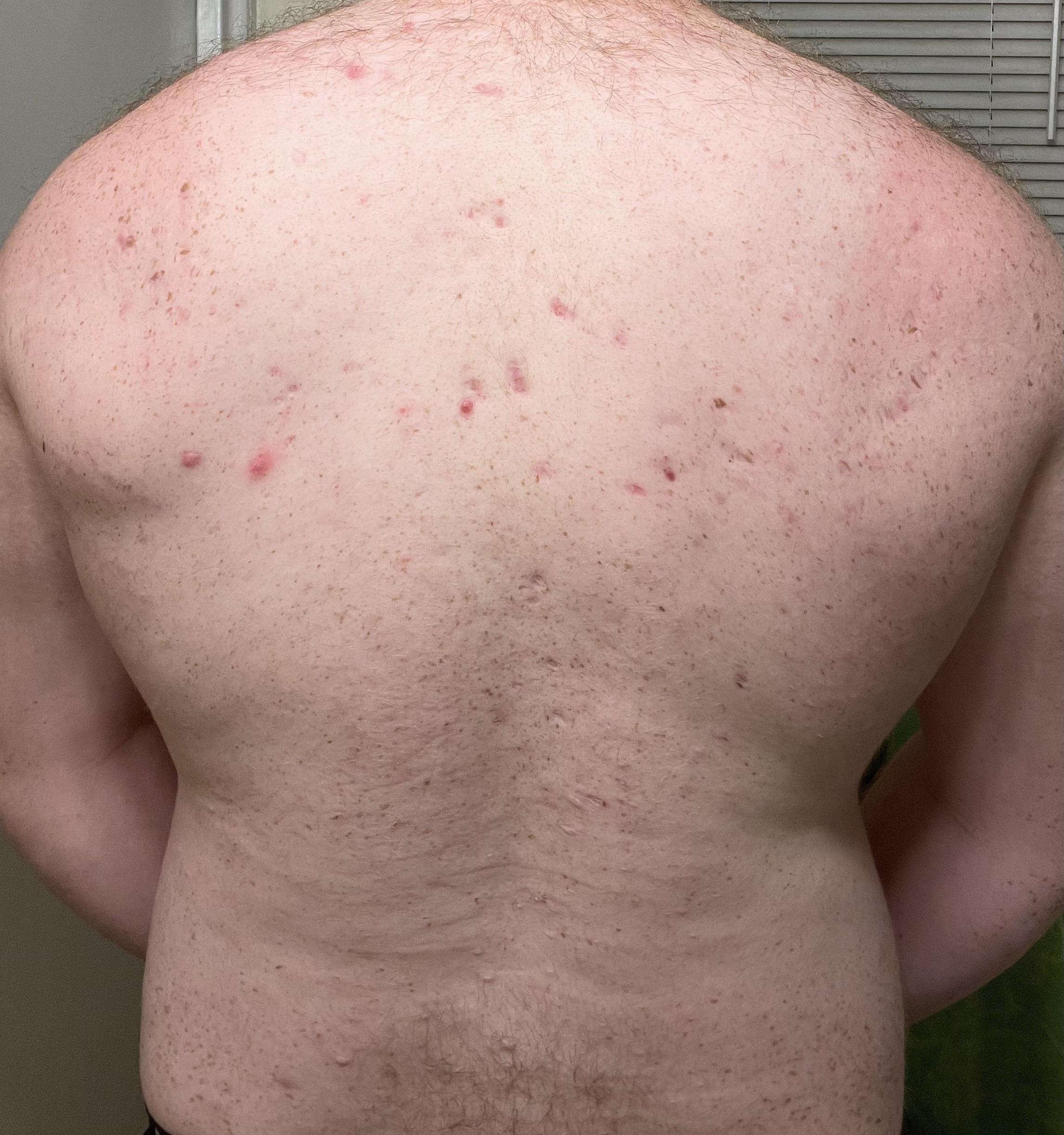 [Acne] Need help fading back acne scars. Is it impossible? I’m