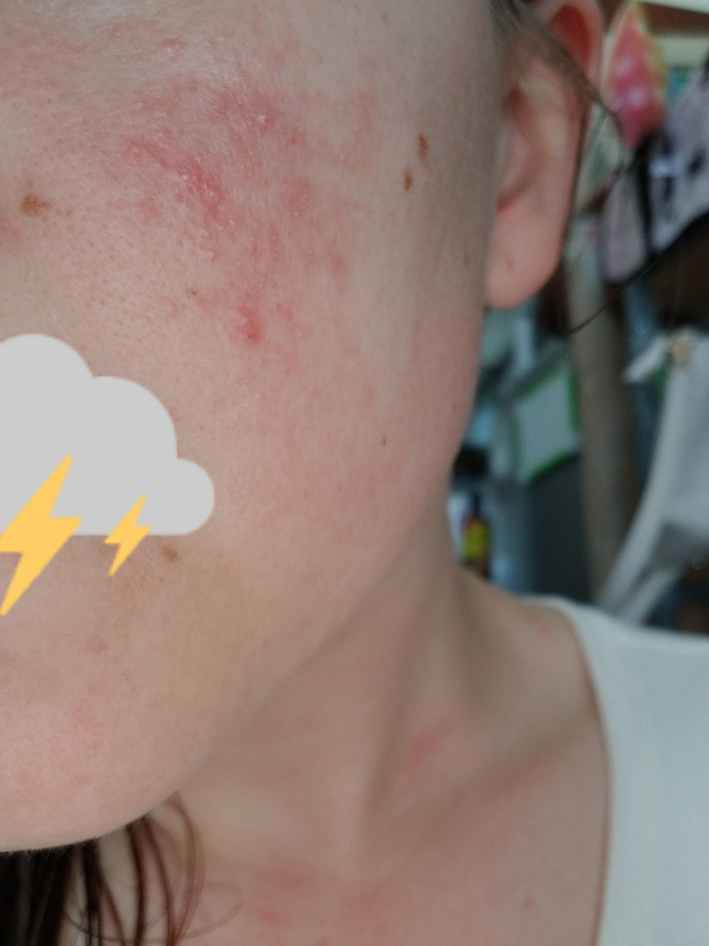 [Skin Concern] Chemical burn (?) from using a moisturizer that didn't