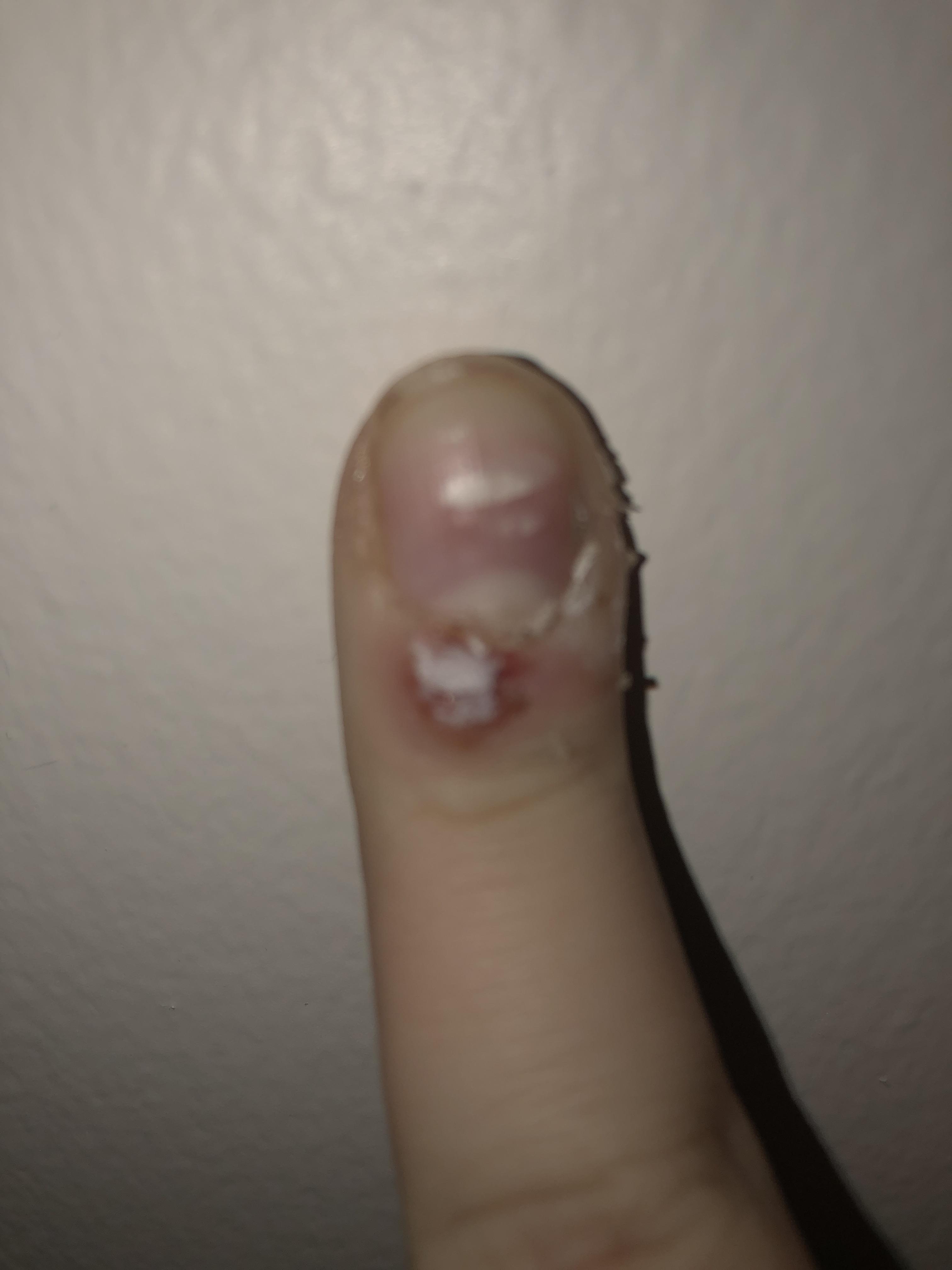 I’ve had this periungual wart for over a year... i have a