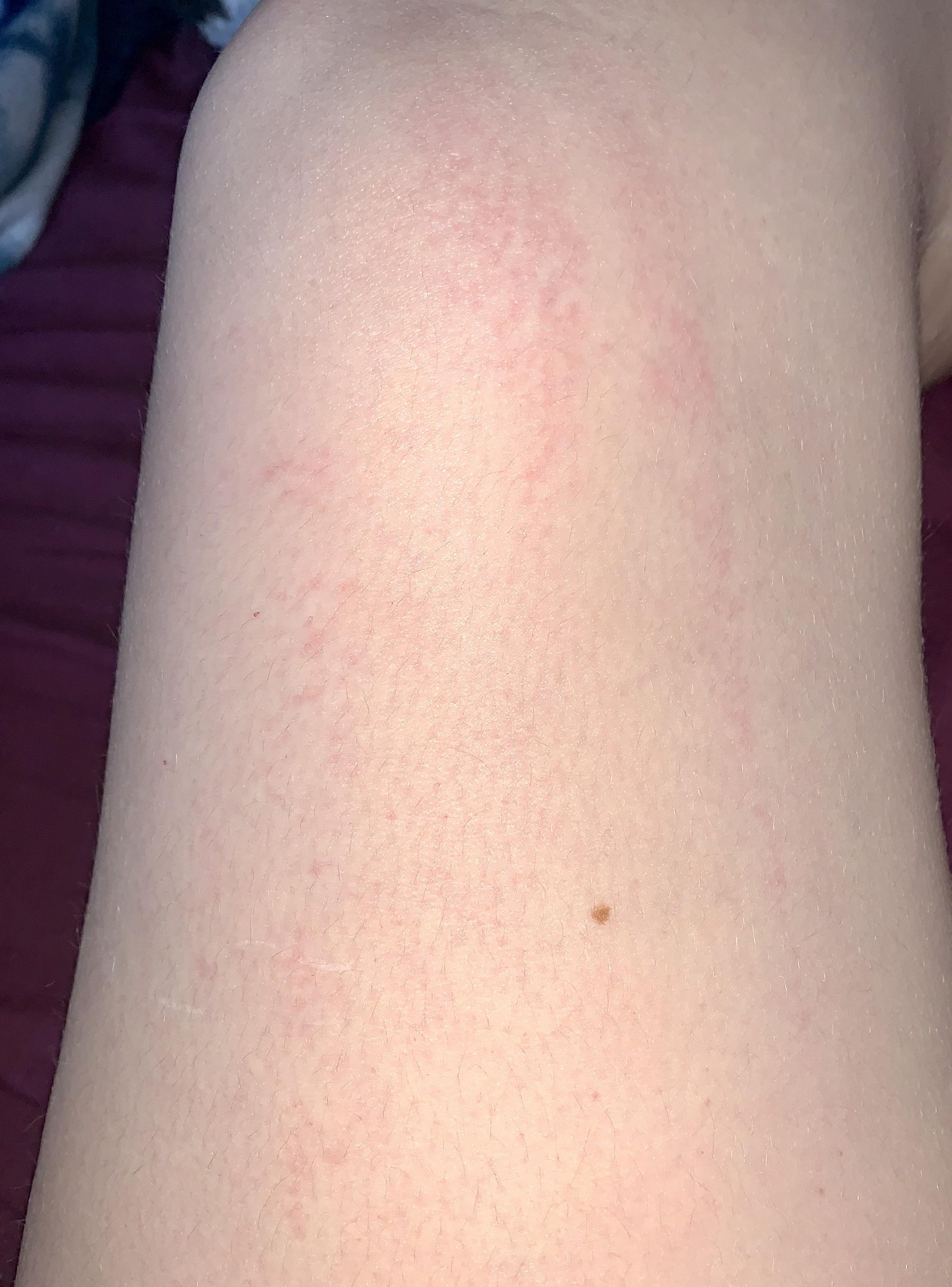 Should I be worried about waking up with legs covered in this rash
