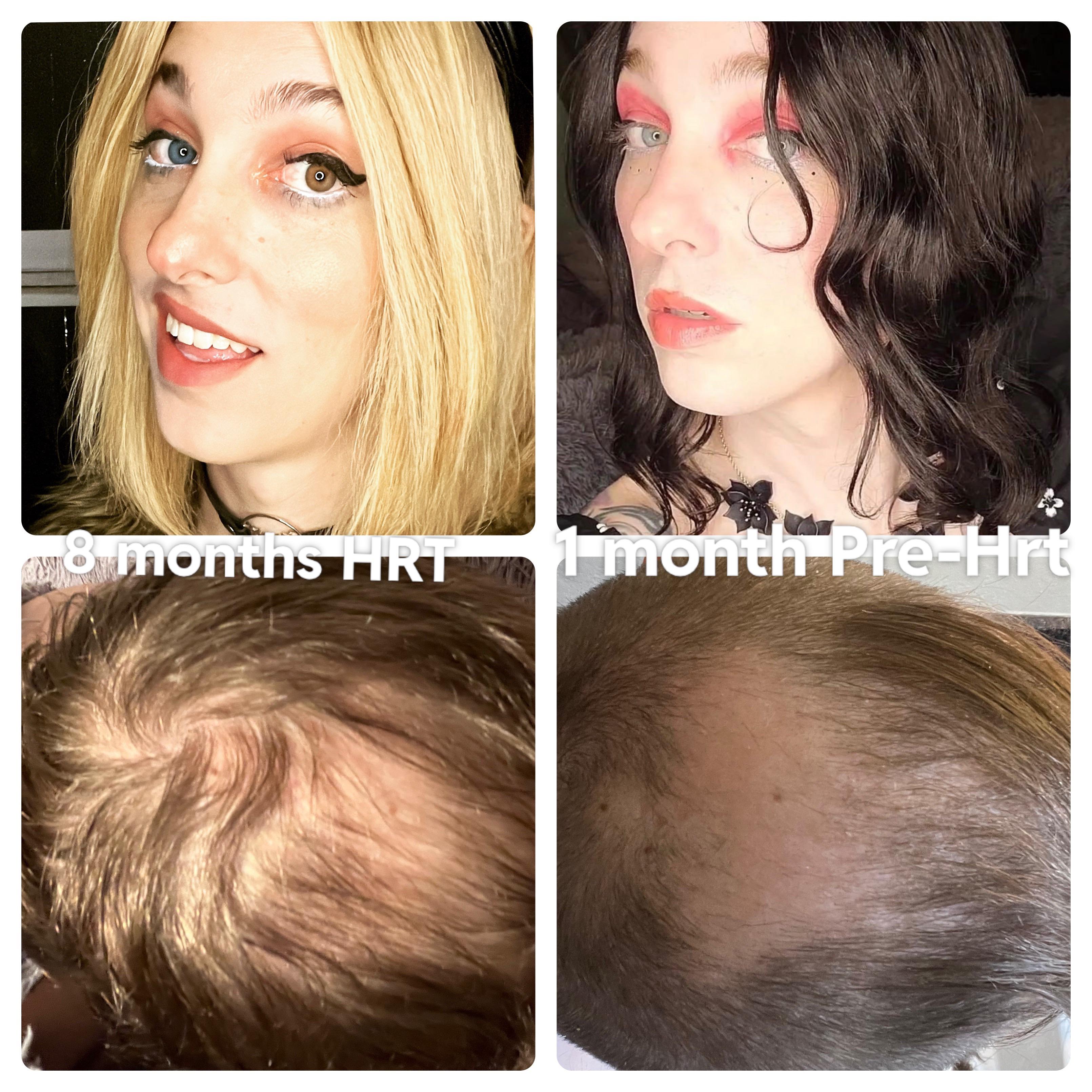 (35 MTF) 8 months of HRT! Not doing much for my face but the hair