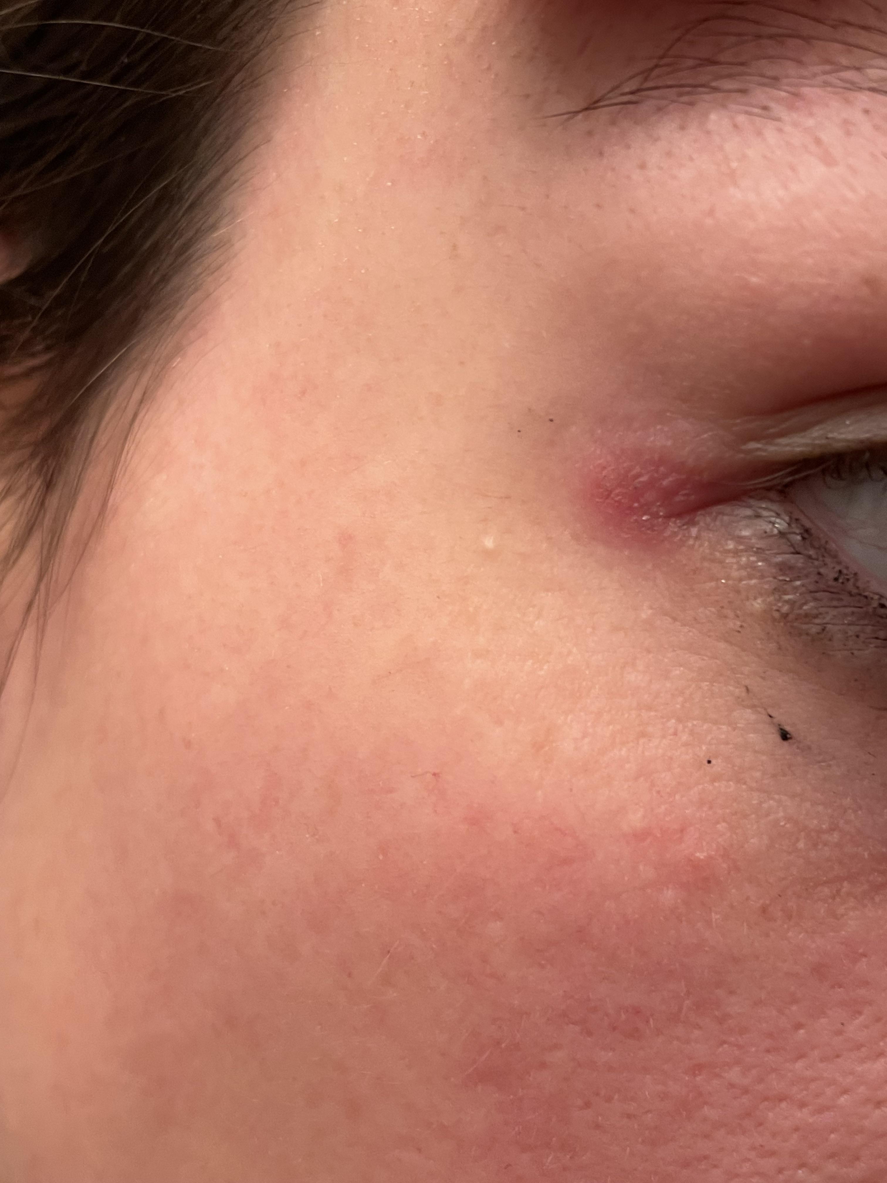 Irritated skin around eyes r/Dermatology