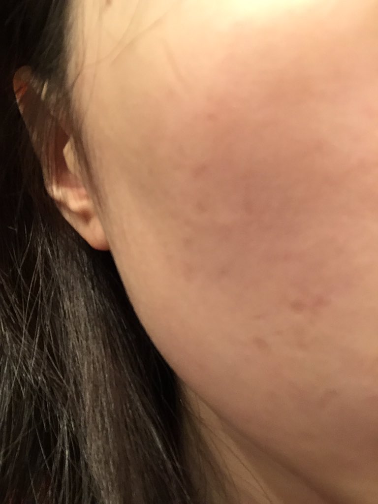 [Skin Concern] Random skin indentations on face. What could be the