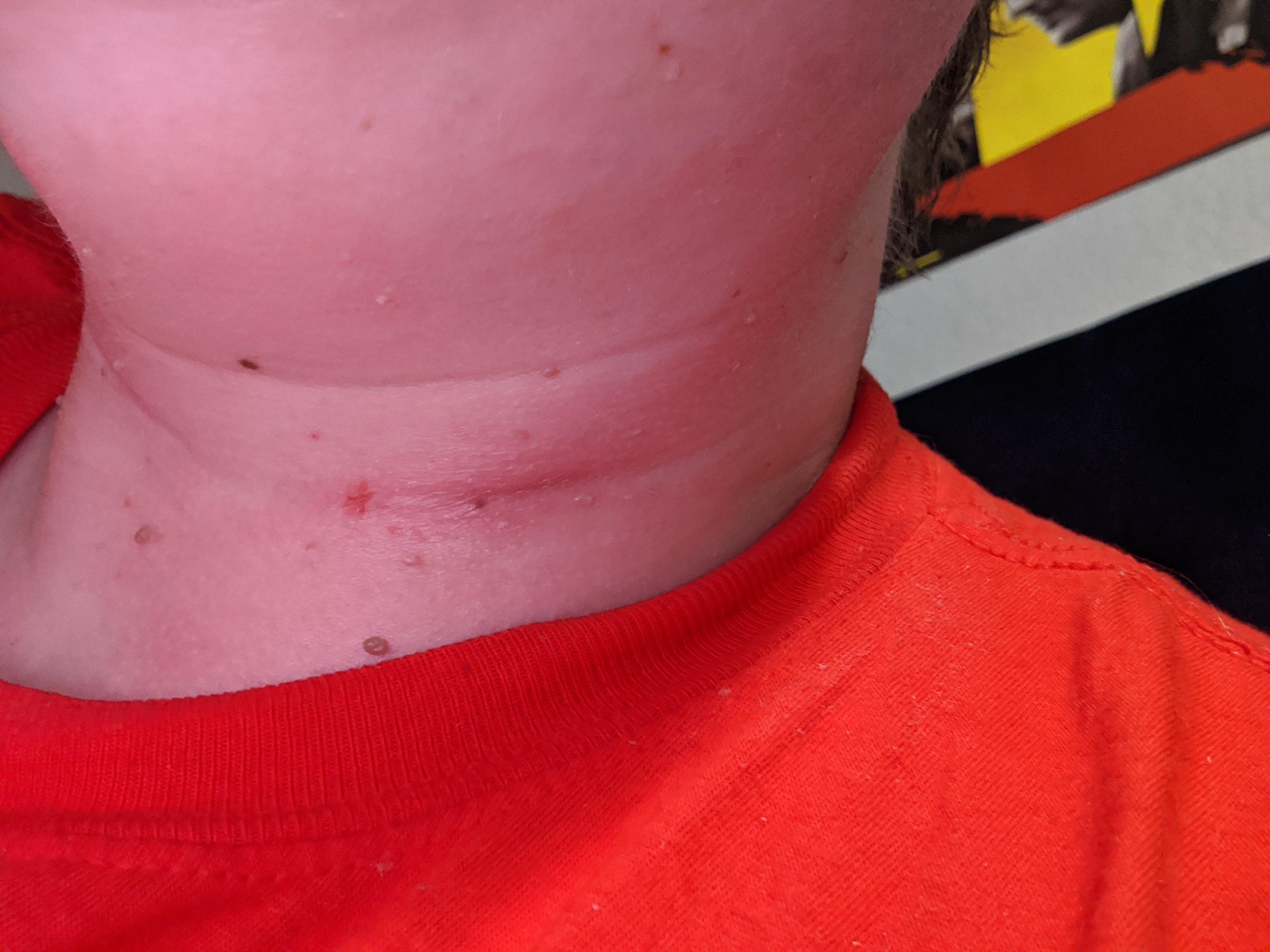 [Skin concern] Anyone know what this redness on my neck is? It hurts