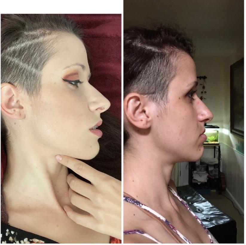 Profile view Before and after jaw surgery for underbite r/jawsurgery