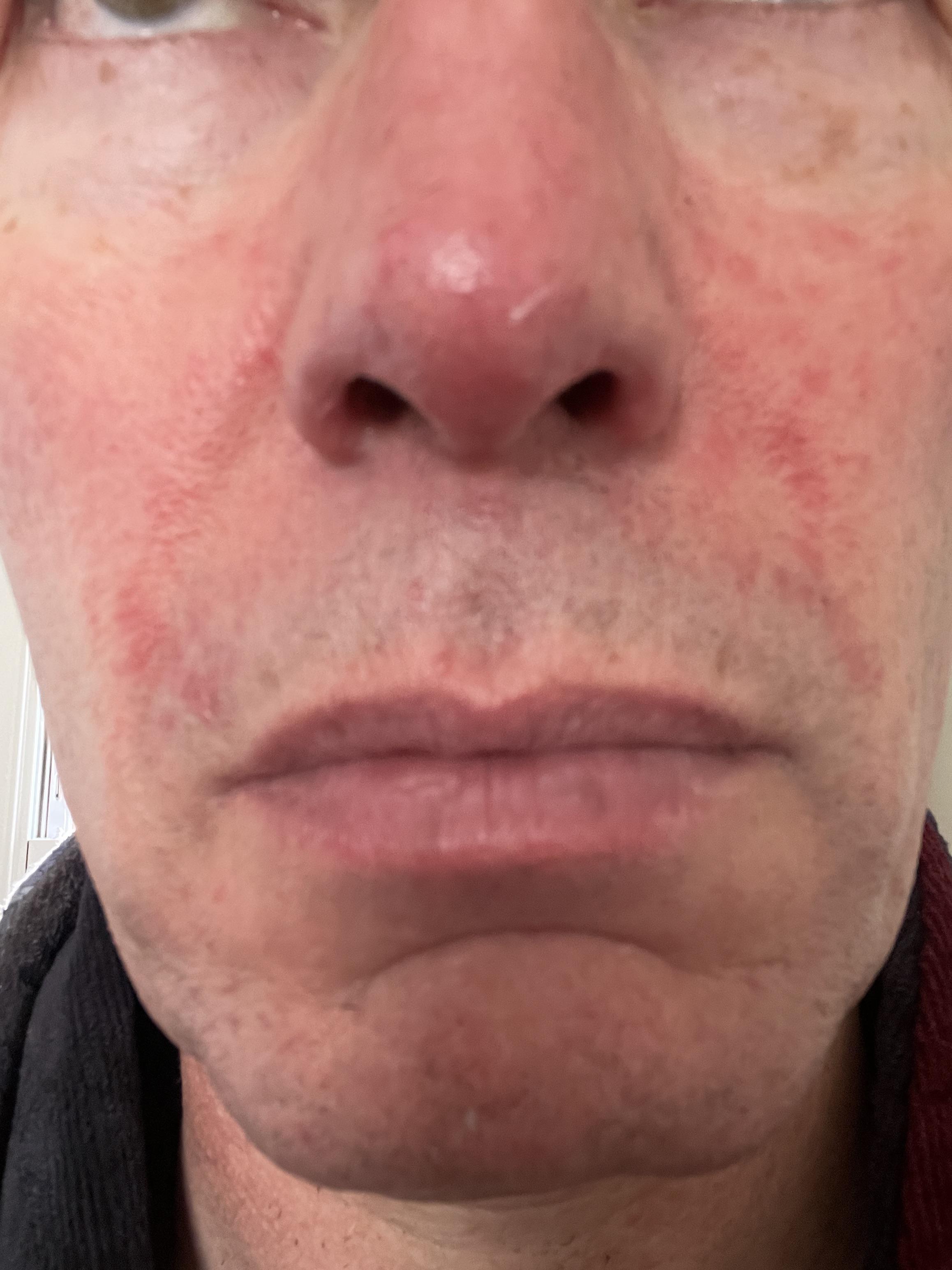 Gluten face? r/glutenfree