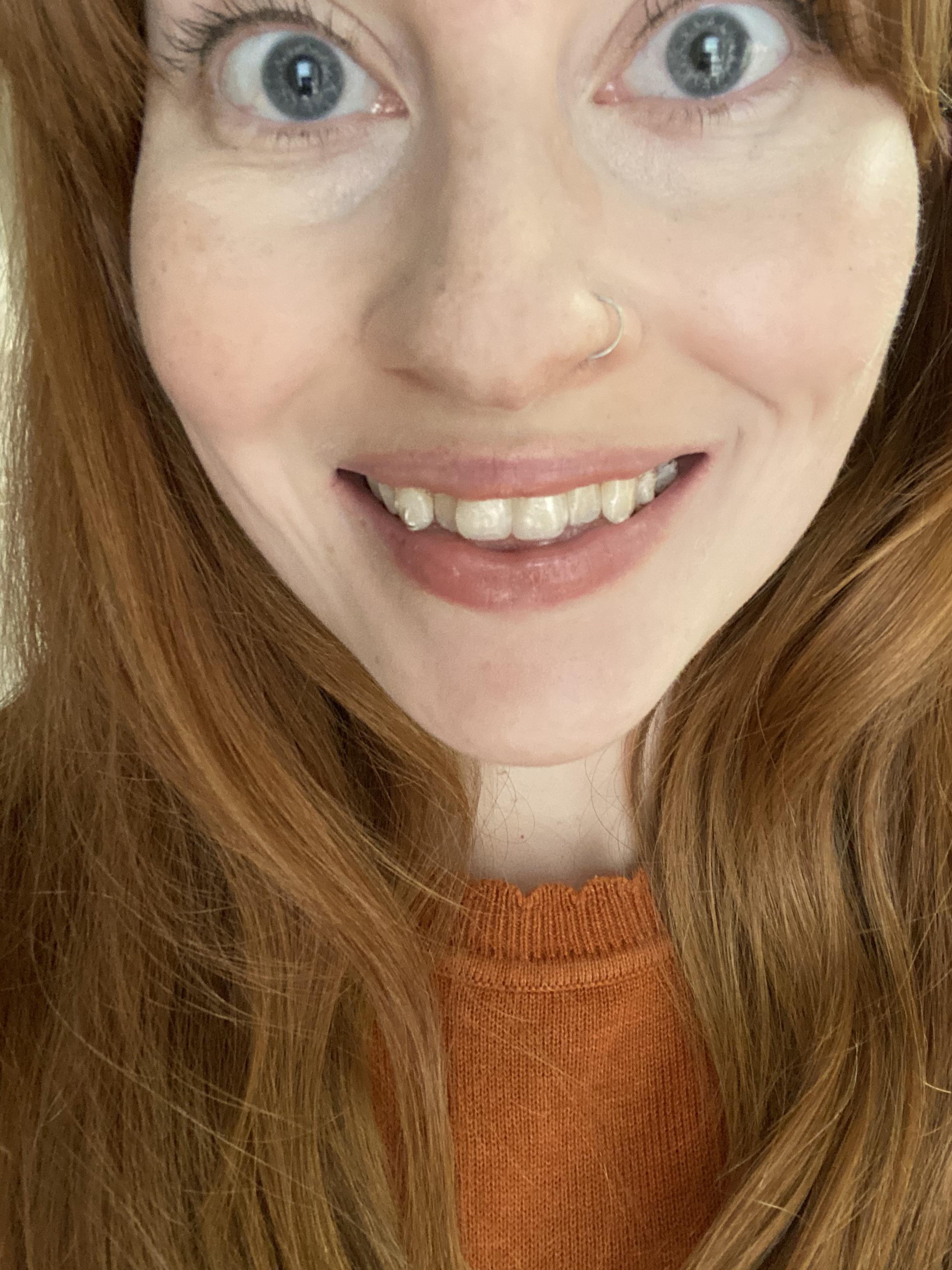 Tray 1! Removing my wisdom teeth before starting Invisalign almost