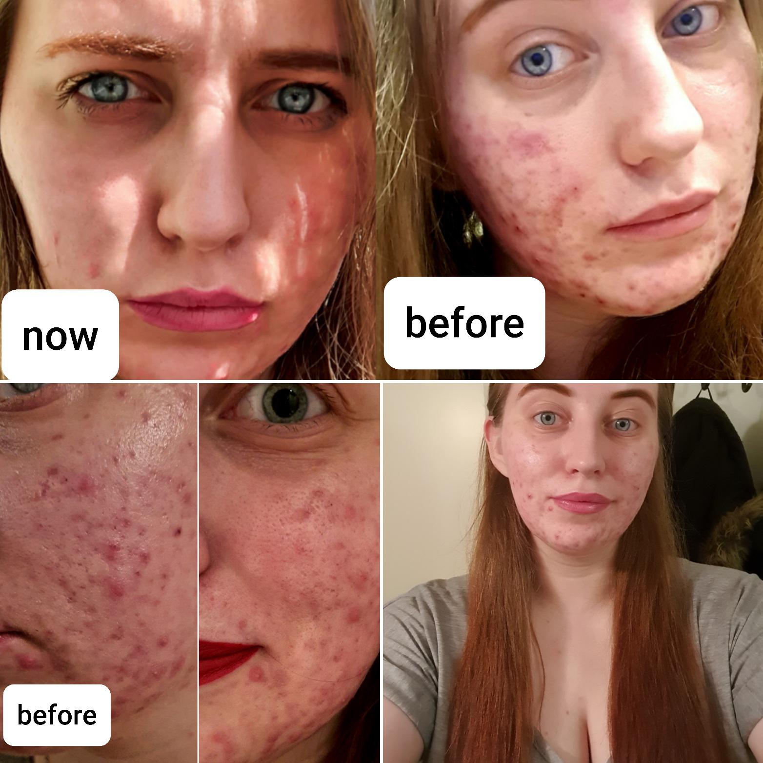 First Time I Feel Comfortable Showing My Skin In Years!!!, 46 OFF