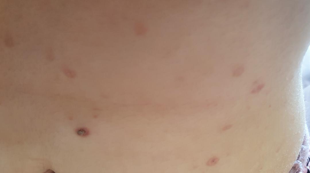 I need for products to get rid of these brownish marks