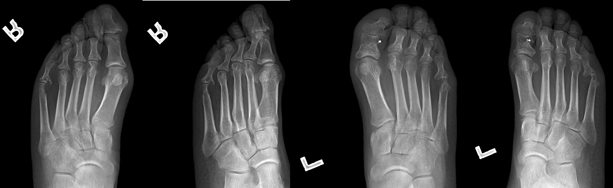 Bilateral Foot Pain r/RadiHolidayCases