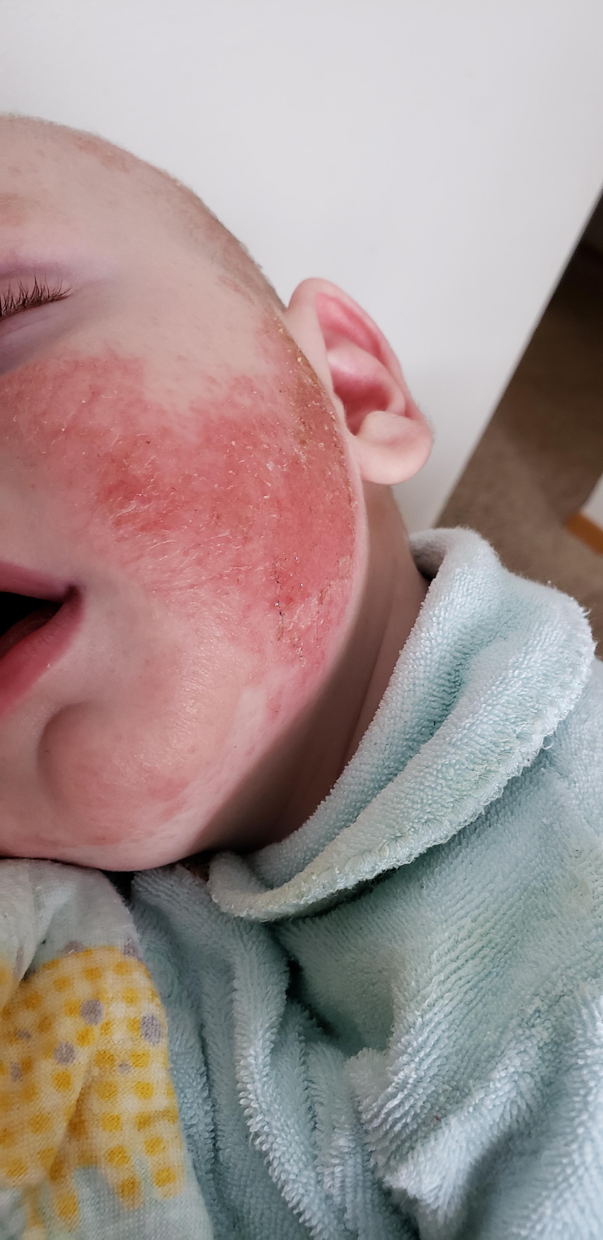Needing advice on my son's weeping exema. We've tried a steroid creme