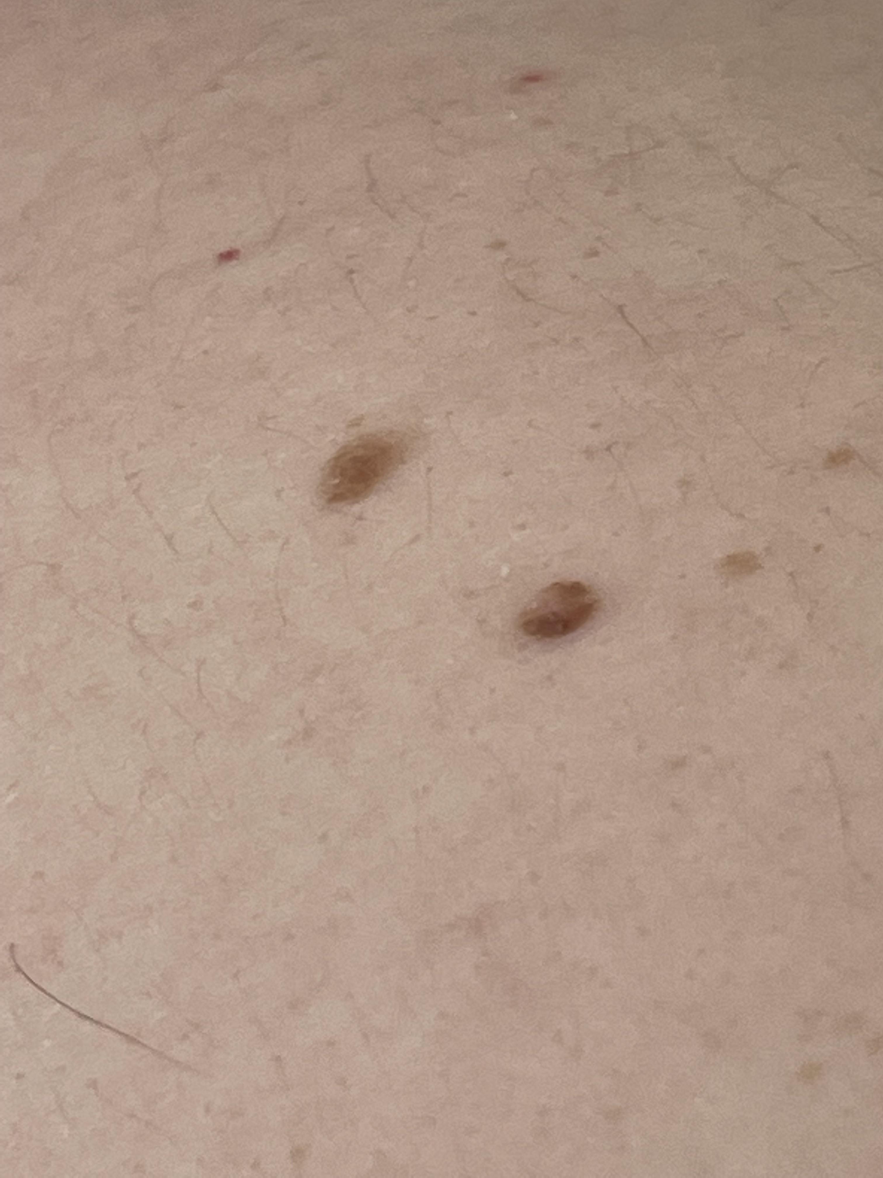 Anyone ever had part of a mole scab then after it’s fallen off the