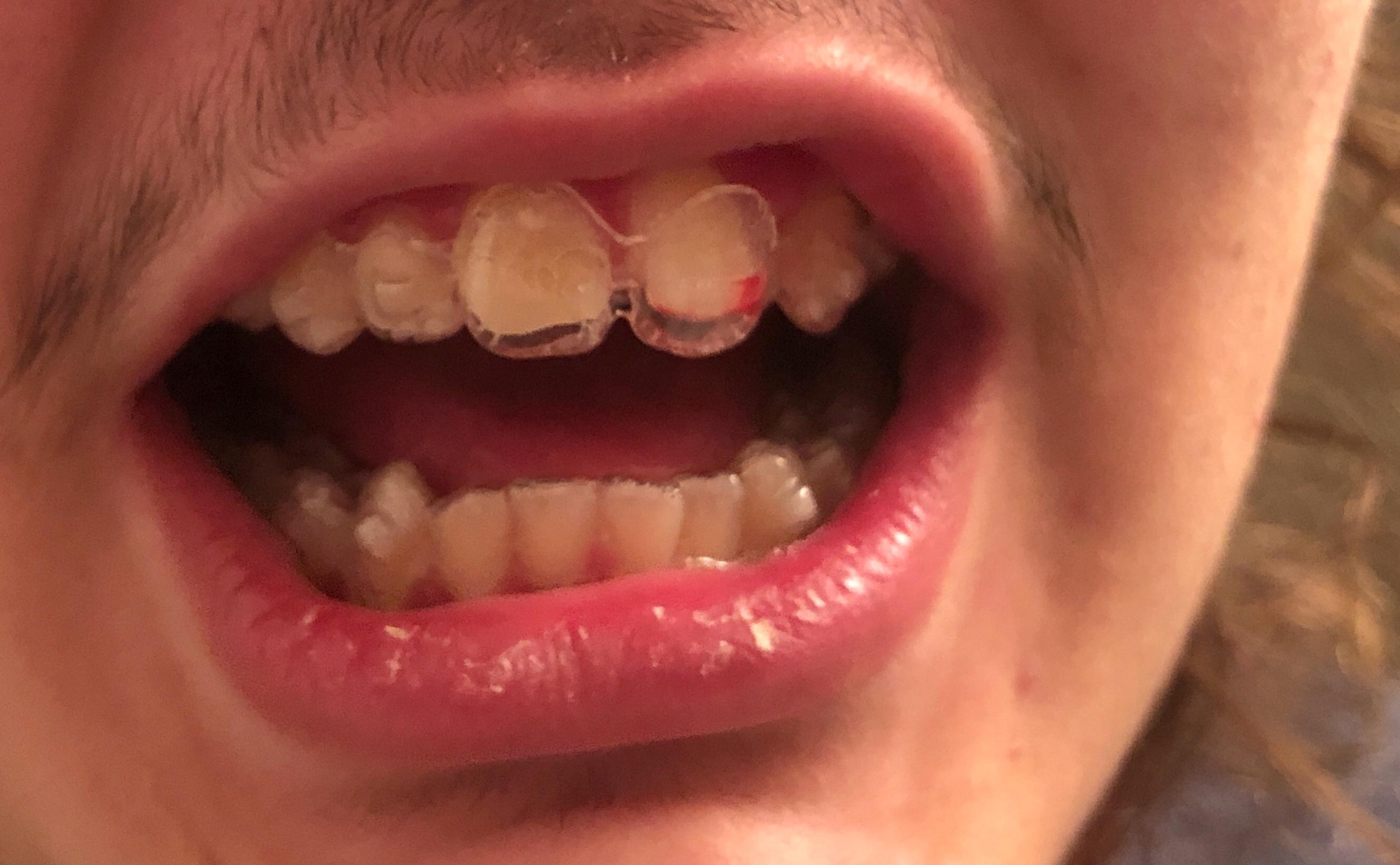 Gap Teeth Invisalign