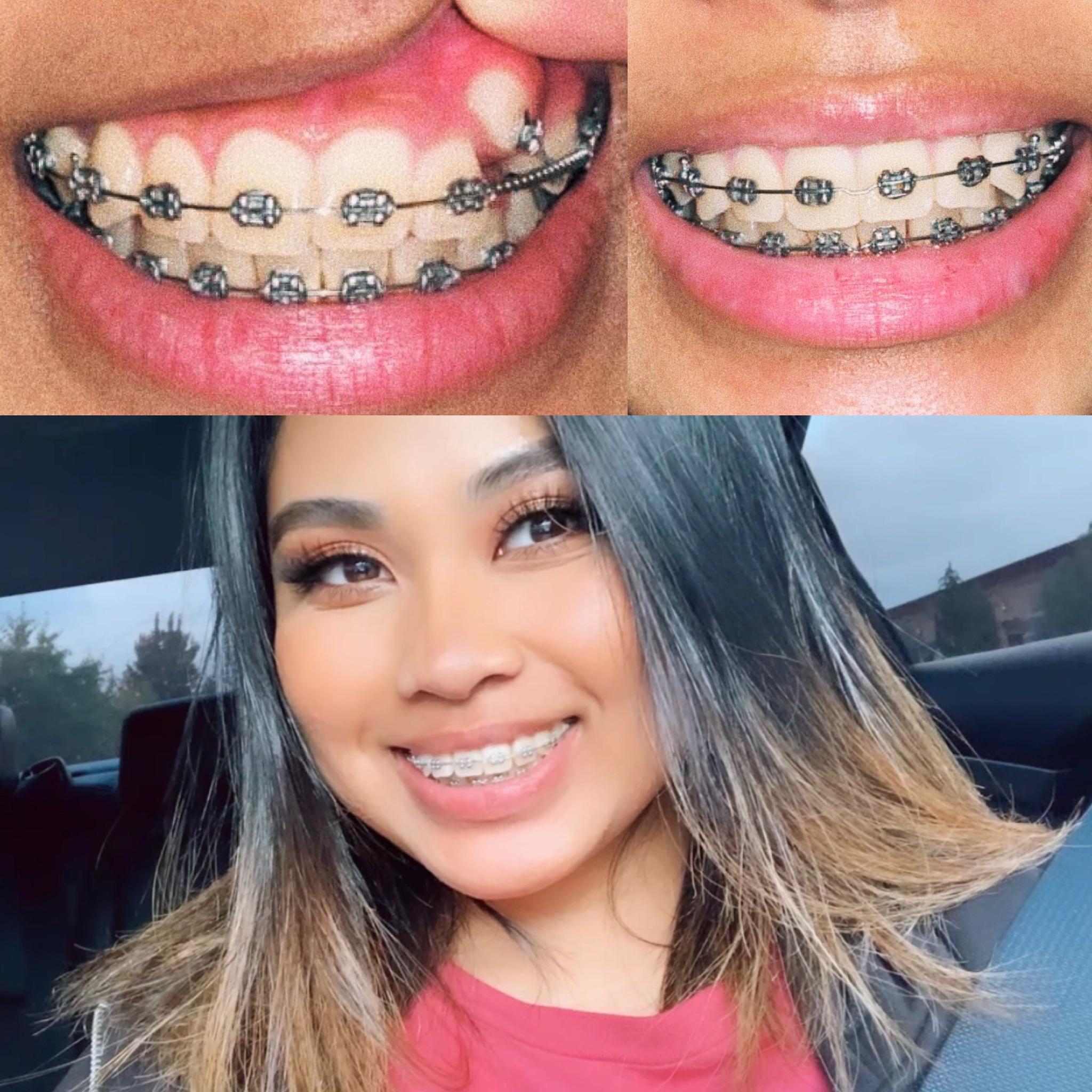 Impacted canine one year difference! Still have a couple more months